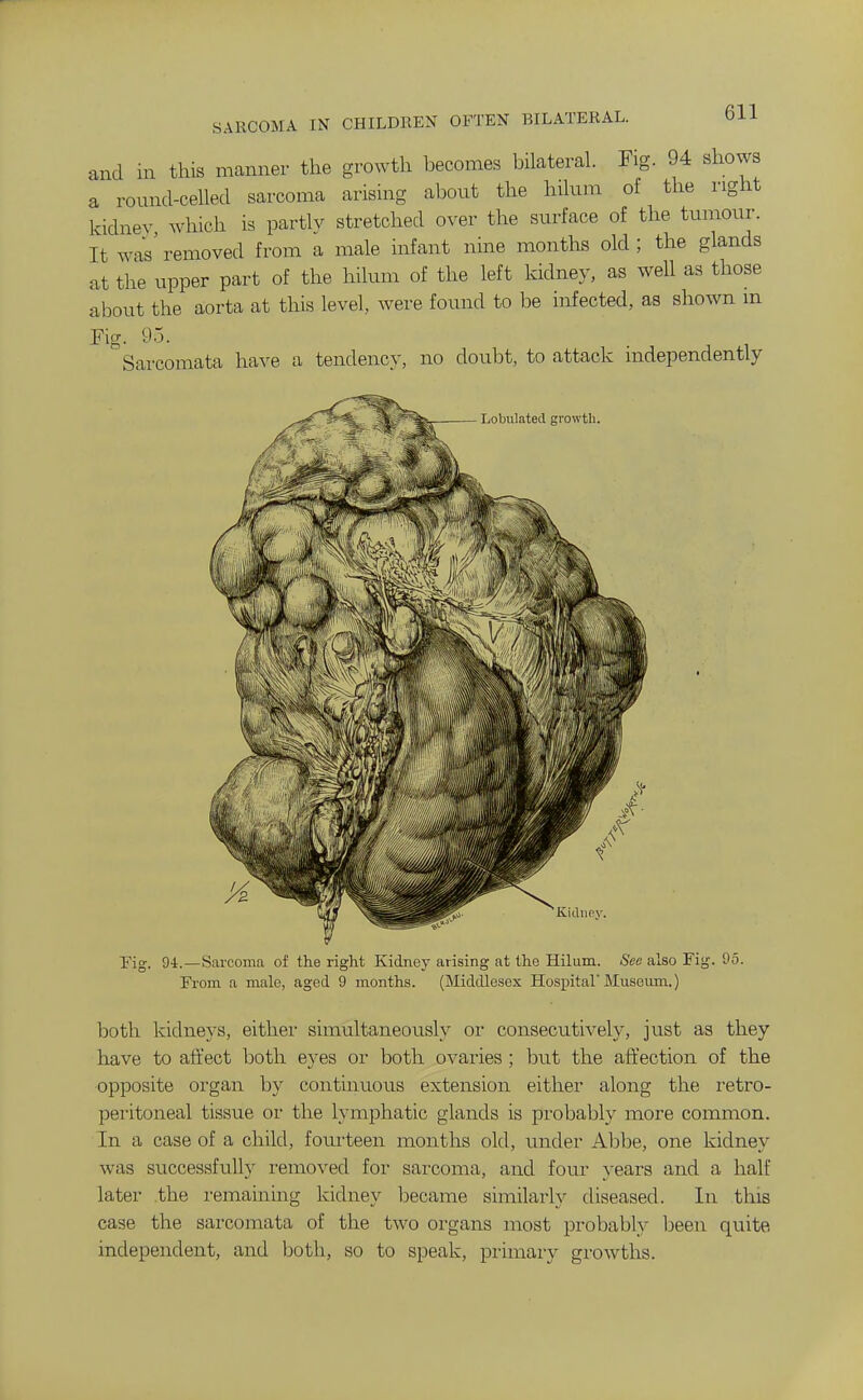 and in this manner the growth becomes bilateral. Fig. 94 shows a round-celled sarcoma arising about the hilum of the right kidney which is partly stretched over the surface of the tumour. It was' removed from a male infant nine months old ; the glands at the upper part of the hilum of the left kidney, as well as those about the aorta at this level, were found to be infected, as shown m Fig. 95. Sarcomata have a tendency, no doubt, to attack mdependently Lobulated growth. Kiilnfiy. Fig. 94.—Sarcoma of the right Kidney arising at the Hilum. See also Fig. 95. From a male, aged 9 months. (Middlesex Hospital'Museimi.) both kidneys, eithei- simultaneoiisly or consecutively, just as they have to affect both eyes or both ovaries ; but the affection of the opposite organ by continuous extension either along the retro- peritoneal tissue or the lymphatic glands is probably more common. In a case of a child, foui'teen months old, under Abbe, one kidney was successfully removed for sarcoma, and four years and a half later the remaining kidney became similarly diseased. In this case the sarcomata of the two organs most probably been quite independent, and both, so to speak, primary growths.