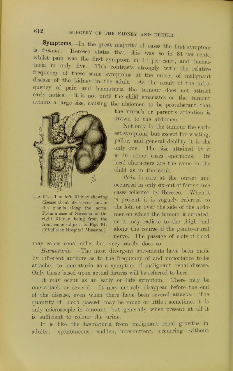 Syinptoms.-In the great majority of cases the first svmi^tom tumour. Heresco states that this was so in 81 per cent whilst pam was the iirst symptom in 14 per cent., and heema^ tuna m only five. This contrasts strongly with the relative frequency of these same symptoms at the outset of malignant disease of the kidney in the adult. As the result of the infre- quency of pam and hematuria the tumour does not attract early notice. It is not until the child emaciates or the tumour attains a large size, causkg the abdomen to be protuberant, that the nurse's or parent's attention is drawn to the abdomen. Not only is the tumour the earli- est symptom, but except for wasting, pallor, and general debility it is the only one. The size attained by it is in some cases enormous. Its local characters are the same in the child as in the 'adult. Pain is rare at the outset and occurred in only six out of forty-three cases collected by Heresco. When it is present it is vaguely referred to the loin or over the side of the abdo- men on which the tumour is situated, or it may radiate to the thigh and along the course of the genito-crural nerve. The passage of clots of blood may cause i-eiial colic, but very rarely does so. Hcematuria. — The most divergent statements have been made by different authoi's as to the frequency of and importance to be attached to hsematuria as a symptom of malignant i-enal disease. Only those based upon actual figures will be referred to here. It may occur as an early or late symptom. There may be one attack or several. It may entii'ely disappear before the end of the disease, even when there have been several attacks. The quantity of blood passed may be imich or little; sometimes it is only microscopic in amount, but generally when present at all it is sufficient to colour the urine. It is like the hsematuria from malignant renal growths in adults: spontaneous, sudden, intermittent, occurring without Fi . 95.—The left Kidney stowing disease atout its A'essels and in the glands along the aorta. From a case of Sarcoma of the right Kidney, being from the from same subject as I'ig. 94. (Middlesex Hospital Museum.)