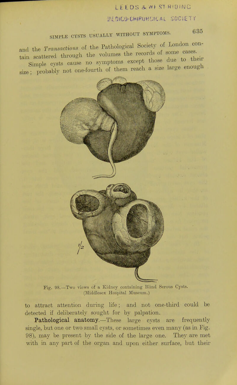 Lt IDS A SI WiOiNC SIMPLE CYSTS USUALLY WITHOUT SYMPTOMS. 635 and the Transactions of the Pathological So.ety f ^^'^. s tain scattered through the volumes the recoi. s of some cas s. Simple cysts cause no symptoms except those due to their size probably not one-fourth of them reach a size large enough Fig. 98.—Two viows of a Kidney containing Blind Serous Cysts. (Middlesex Hospital Museum.) to attract attention durmg life; and not one-third could be detected if deliberately sought for by palpation. Pathological anatomy.—These large cysts are frequently single, but one or two small cysts, or sometimes even many (as in Fig. 98), may be present by the side of the large one. They are met with in any part of the organ and upon either surface, but their