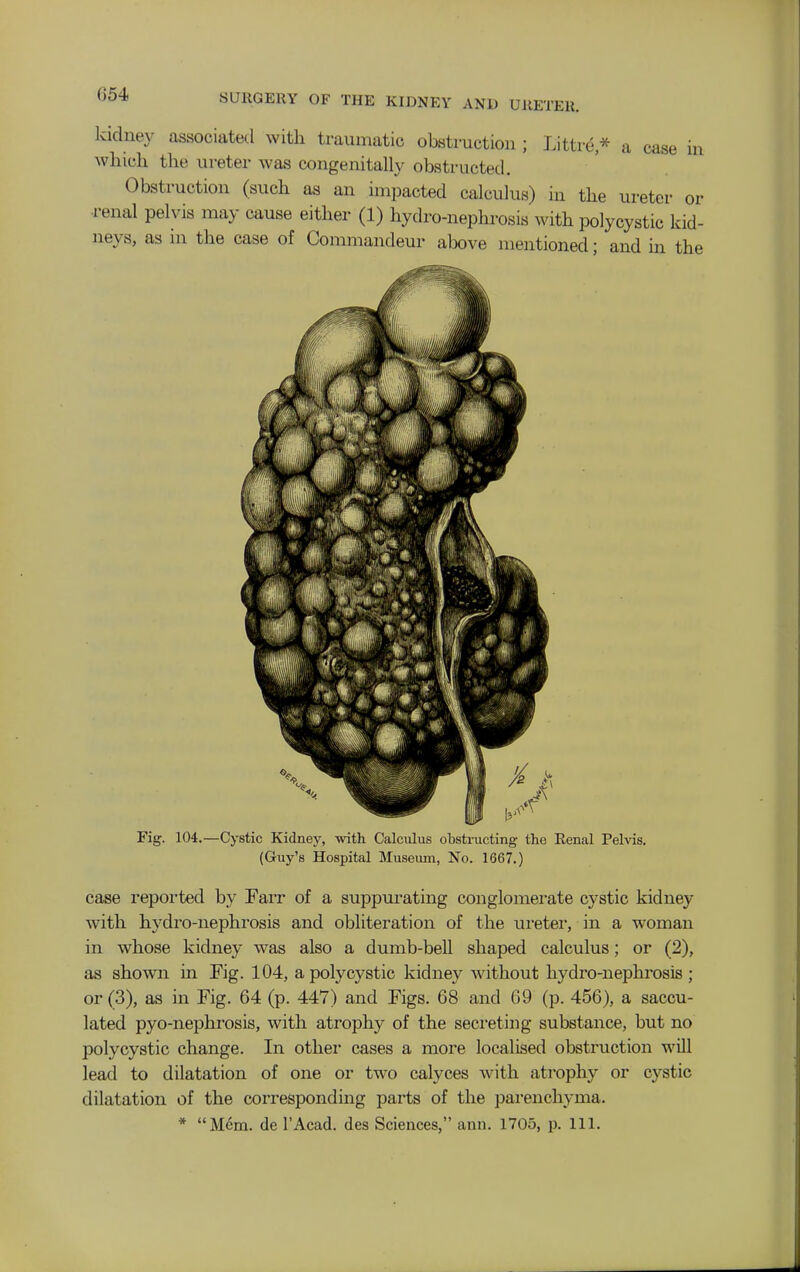 kidney associated with traumatic obstruction; Littre,* a case in which the ureter was congenitally obstructed. Obstruction (such as an impacted calculus) in the ureter or renal pelvis may cause either (1) hydro-nephrosis with polycystic kid- neys, as in the case of Commandeur above mentioned; and in the Fig. 104.—Cystic Kidney, with Calciilus obstructing the Renal Pelvis. (Guy's Hospital Museimi, No. 1667.) case reported by Farr of a suppurating conglomerate cystic kidney with hydro-nephrosis and obliteration of the ureter, in a woman in whose kidney was also a dumb-bell shaped calculus; or (2), as shown in Fig. 104, a polycystic kidney without hydro-nephrosis; or (3), as in Fig. 64 (p. 447) and Figs. 68 and 69 (p. 456), a saccu- lated pyo-nephrosis, with atrophy of the secreting substance, but no polycystic change. In othei cases a more localised obstruction will lead to dilatation of one or two calyces with atrophy or cystic dilatation of the corresponding parts of the parenchyma. Mem. de I'Acad. des Sciences, ann. 1705, p. 111.