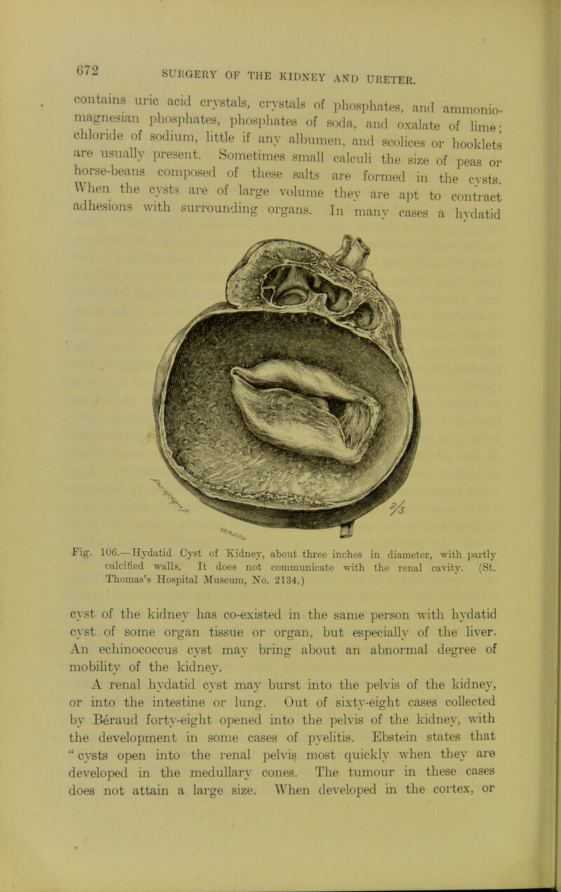 contains uric acid crystals, cryst^ils of phosphates, and ammonio- magnesian phosphates, phospJaates of soda, and oxalate of lime- chloride of sodium, httle if any albumen, and scolices or hooklets are usually present. Sometimes small calculi the size of peas or horse-beans composed of these salts are formed in the cysts When the cysts are of large volume they are apt to contract adhesions with surrounding organs. In manv cases a hydatid Fig. 106.—Hydatid Cyst of Kidney, about three inches in diameter, with partly calcified walls. It does not commnnicate with the renal ca^dty. (St. Thomas's Hospital Museum, No. 2134.) cyst of the kidney has co-existed in the same person with hydatid C3'st of some organ tissue or organ, but especially of the liver. An echinococcus cyst may bring about an abnormal degree of mobility of the kidney. A renal hydatid cyst may burst into the pelvis of the kidney, or into the intestine or lung. Out of sixty-eight cases collected by Beraud forty-eight opened into the pelvis of the kidney, with the development in some cases of pyelitis. Ebstein states that  cysts open into the renal pelvis most quickly when they are developed in the medullary cones. The tumour in these cases does not attain a large size. When developed in the cortex, or