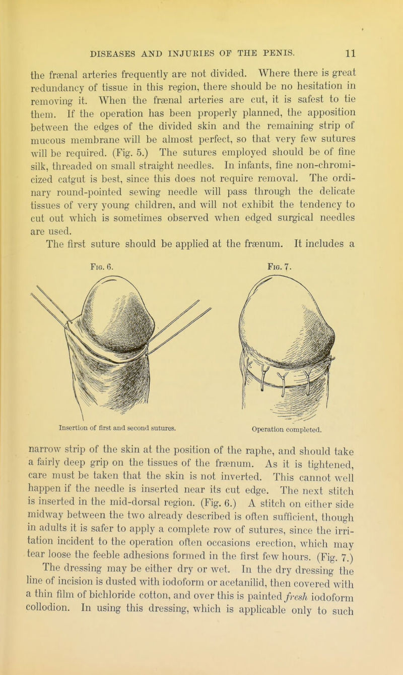 the frsenal arteries frequently are not divided. Where there is great redundancy of tissue in this region, there should be no hesitation in removing it. When the frsenal arteries are cut, it is safest to tie them. If the operation has been properly planned, the apposition between the edges of the divided skin and the remaining strip of mucous membrane will be almost perfect, so that very few sutures will be rec|uired, (Fig. 5.) The sutures employed should be of fine silk, threaded on small straight needles. In infants, fine non-chromi- cized catgut is best, since this does not require removal. The ordi- nary round-pointed sewing needle will pass through the delicate tissues of very young children, and will not exhibit the tendency to cut out which is sometimes observed when edged surgical needles are used. The first suture should be apphed at the frasnum. It includes a Fig. 6. Fig. 7. Insertion of first and second sutures. Operation completed. narrow strip of the skin at the position of the raphe, and should take a fairly deep grip on the tissues of the frapnum. As it is tightened, care must be taken that the skin is not inverted. This cannot well happen if the needle is inserted near its cut edge. The next stitch is inserted in the mid-dorsal region. (Fig. 6.) A stitch on either side midway between the two already described is often sufficient, though in adults it is safer to apply a complete row of sutures, since the irri- tation incident to the operation often occasions erection, which may tear loose the feeble adhesions formed in the first few hours. (Fig. 7.) The dressing may be either dry or wet. In the dry dressing the line of incision is dusted with iodoform or acetanilid, then covered with a thin film of bichloride cotton, and over this is painted frc.^li iodoform collodion. In using this dressing, which is apphcable only to such