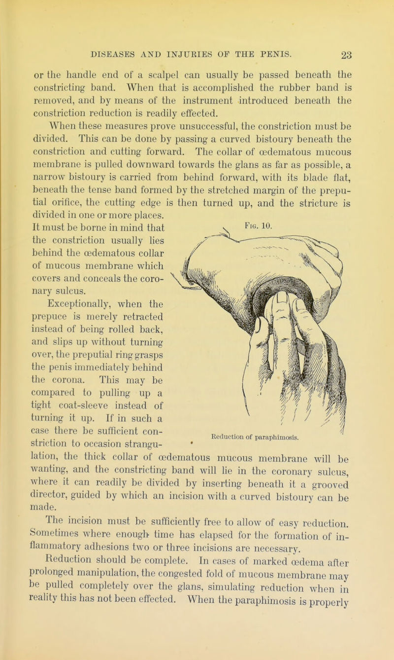 Fig. 10. or the handle end of a scalpel can usually be passed beneath the constricting band. When that is accompHshed the rubber band is removed, and by means of the instrument introduced beneath the constriction reduction is readily effected. When these measures prove unsuccessful, the constriction must be divided. This can be done by passing- a curved bistoury beneath the constriction and cutting forward. The collar of oedematous mucous membrane is pulled downward towards the glans as far as possible, a narrow bistoury is carried from behind forward, with its blade flat, beneath the tense band formed by the stretched margin of the prepu- tial orifice, the cutting edge is then turned up, and the stricture is divided in one or more places. It must be borne in mind that the constriction usually Hes behind the oedematous collar of mucous membrane which covers and conceals the coro- nary sulcus. Exceptionally, when the prepuce is merely retracted instead of being rolled back, and slips up without turning over, the preputial ring grasps the penis immediately behind the corona. This may be compared to pulling up a tight coat-sleeve instead of turning it up. If in such a case there be sufficient con- ^ , . ... Reduction of paraphimosis. striction to occasion strangu- * lation, the thick collar of oedematous mucous membrane will be wanting, and the constricting band will lie in the coronary sulcus, where it can readily be divided by inserting beneath it a grooved director, guided by which an incision with a curved bistoury can be made. The incision must be sufficiently free to allow of easy reduction. Sometimes where enough time has elapsed for the formation of in- flammatory adhesions two or three incisions are necessary. Reduction should be complete. In cases of marked oedema after prolonged manipulation, the congested fold of mucous membrane may be pulled completely over the glans, simulating reduction when in reality this has not been effected. When the paraphimosis is properly