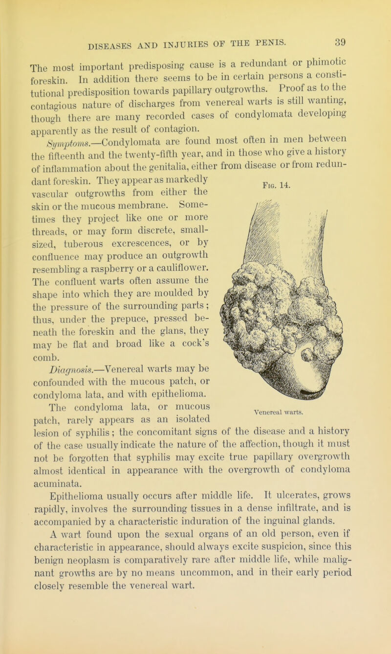 Fig. 14. The most important predisposing cause is a redundant or phimotic foreskin. In addition there seems to be in certain persons a consti- tutional predisposition towards papillary outgrowths. Proof as to the contagious nature of discharges from venereal warts is still wanting, though there are many recorded cases of condylomata developing apparently as the result of contagion. %;i;9^oms.—Condylomata are found most often in men between the fifteenth and the twenty-fifth year, and in those who give a history of inflammation about the genitalia, either from disease or from redun- dant foreskin. They appear as markedly vascular outgrowths from either the skin or the mucous membrane. Some- times they project like one or more threads, or may form discrete, small- sized, tuberous excrescences, or by confluence may produce an outgrowth resembling a raspberry or a cauliflower. The confluent warts often assume the shape into which they are moulded by the pressure of the surrounding parts; thus, under the prepuce, pressed be- neath the foreskin and the glans, they may be flat and broad like a cock's comb. Diagnosis.—Venereal warts may be confounded with the mucous patch, or condyloma lata, and with epithelioma. The condyloma lata, or mucous patch, rarely appears as an isolated lesion of syphilis; the concomitant signs of the disease and a history of the case usually indicate the nature of the affection, though it must not be forgotten that syphilis may excite true papillary overgrowth almost identical in appearance with the overgrowth of condyloma acuminata. Epithelioma usually occurs after middle life. It ulcerates, grows rapidly, involves the surrounding tissues in a dense infiltrate, and is accompanied by a characteristic induration of the inguinal glands. A wart found upon the sexual organs of an old person, even if characteristic in appearance, should always excite suspicion, since this benign neoplasm is comparatively rare after middle life, while malig- nant growths are by no means uncommon, and in their early period closely resemble the venereal wart. Venereal warts.