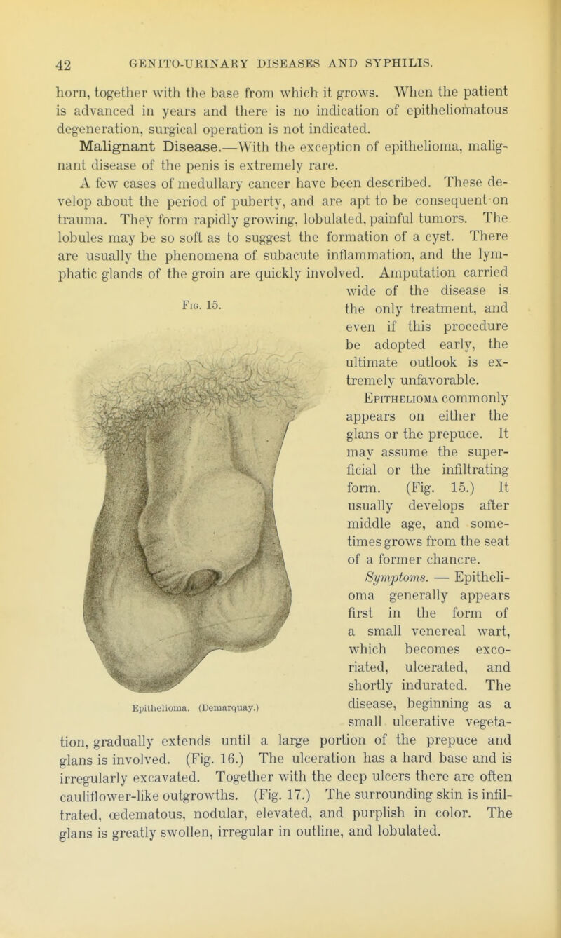 horn, together with the base from which it grows. When the patient is advanced in years and there is no indication of epitheUomatous degeneration, surgical operation is not indicated. Malignant Disease.—With the exception of epithehoma, malig- nant disease of the penis is extremely rare. A few cases of medullary cancer have been described. These de- velop about the period of puberty, and are apt to be consequent on trauma. They form rapidly growing, lobulated, painful tumors. The lobules may be so soft as to suggest the formation of a cyst. There are usually the phenomena of subacute inflammation, and the lym- phatic glands of the groin are quickly involved. Amputation carried wide of the disease is F'^-the only treatment, and even if this procedure be adopted early, the ultimate outlook is ex- tremely unfavorable. Epithelioma commonly appears on either the glans or the prepuce. It may assume the super- ficial or the infiltrating form. (Fig. 15.) It usually develops after middle age, and some- times grows from the seat of a former chancre. Sym2:)toms. — Epitheli- i| oma generally appears first in the form of a small venereal wart, which becomes exco- riated, ulcerated, and shortly indurated. The Epithelioma. (Demarquay.) discase, beginning as a small ulcerative vegeta- tion, gradually extends until a large portion of the prepuce and glans is involved. (Fig. 16.) The ulceration has a hard base and is irregularly excavated. Together with the deep ulcers there are often cauliflower-like outgrowths. (Fig. 17.) The surrounding skin is infil- trated, oedematous, nodular, elevated, and purphsh in color. The glans is greatly swollen, irregular in outline, and lobulated.