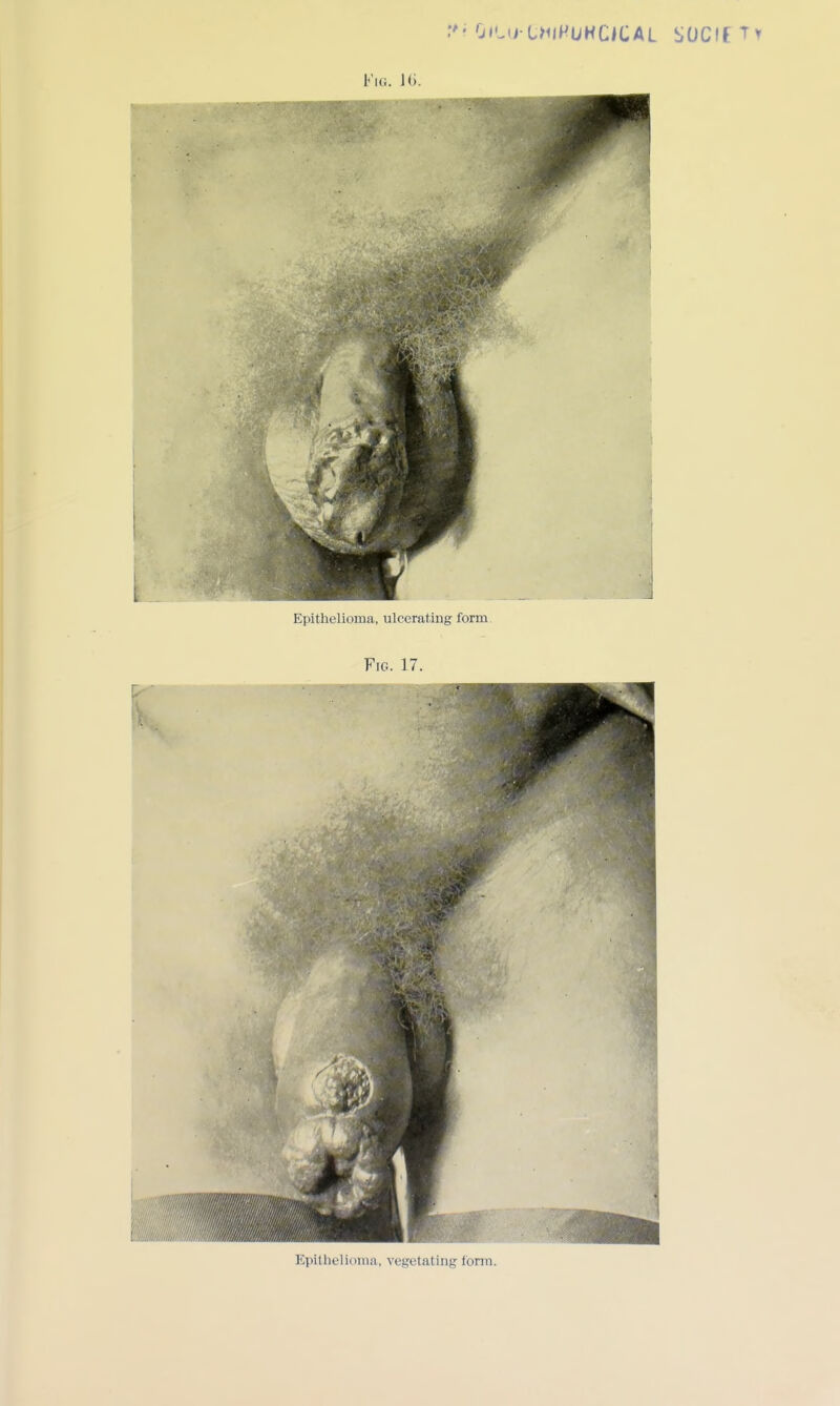 Epithelioma, ulcerating form. Fig. 17. Epithelioma, vegetating form.
