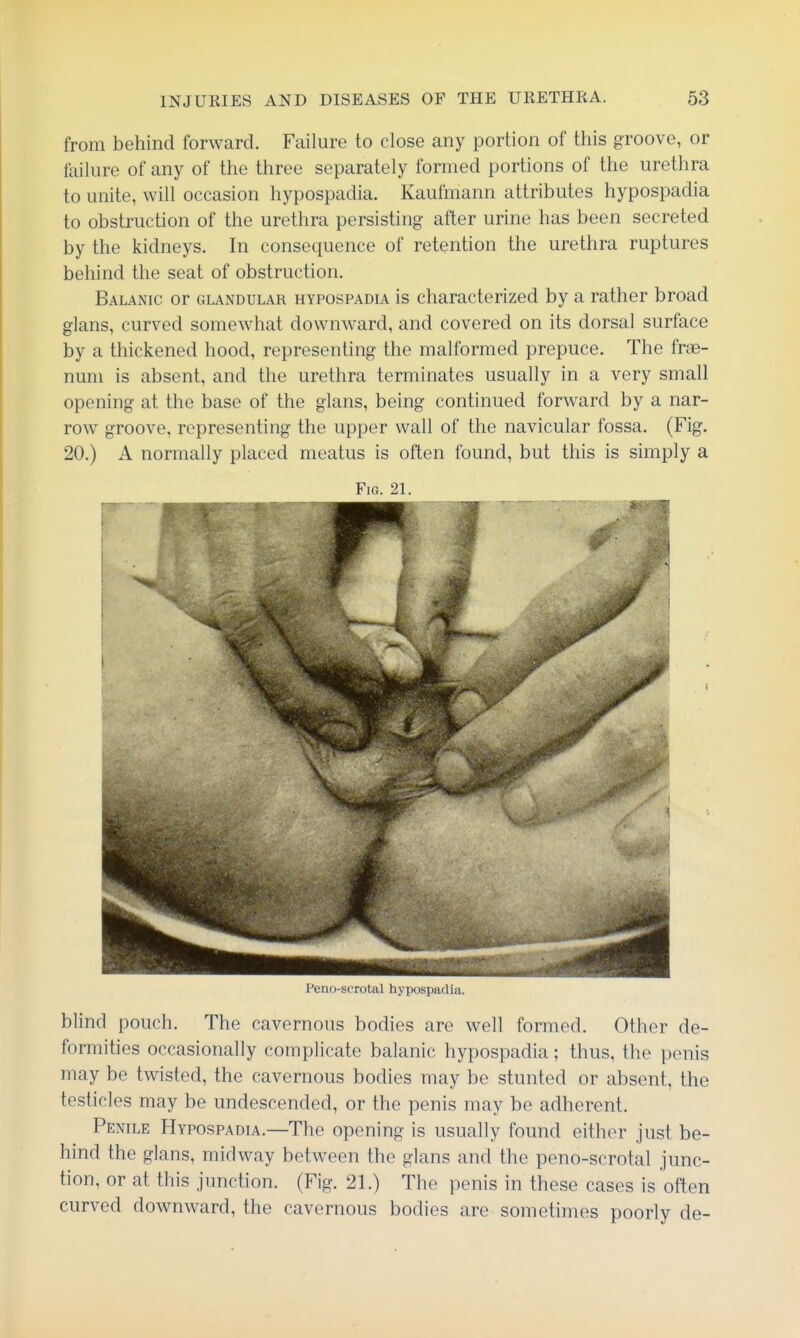 from behind forward. Failure to close any portion of this groove, or failure of any of the three separately formed portions of the urethra to unite, will occasion hypospadia. Kaufmann attributes hypospadia to obstruction of the urethra persisting after urine has been secreted by the kidneys. In consequence of retention the urethra ruptures behind the seat of obstruction. Balanic or GLANDULAR HYPOSPADIA is characterized by a rather broad glans, curved somewhat downward, and covered on its dorsal surface by a thickened hood, representing the malformed prepuce. The frae- num is absent, and the urethra terminates usually in a very small opening at the base of the glans, being continued forward by a nar- row groove, representing the upper wall of the navicular fossa. (Fig. 20.) A normally placed meatus is often found, but this is simply a Fig. 21. Peno-scrotal hypospadia. blind pouch. The cavernous bodies are well formed. Other de- formities occasionally complicate balanic hypospadia; thus, the penis may be twisted, the cavernous bodies may be stunted or absent, the testicles may be undescended, or the penis may be adherent. Penile Hypospadia.—The opening is usually found either just be- hind the glans, midway between the glans and the peno-scrotal junc- tion, or at this junction. (Fig, 21.) The penis in these cases is often curved downward, the cavernous bodies are sometimes poorly de-