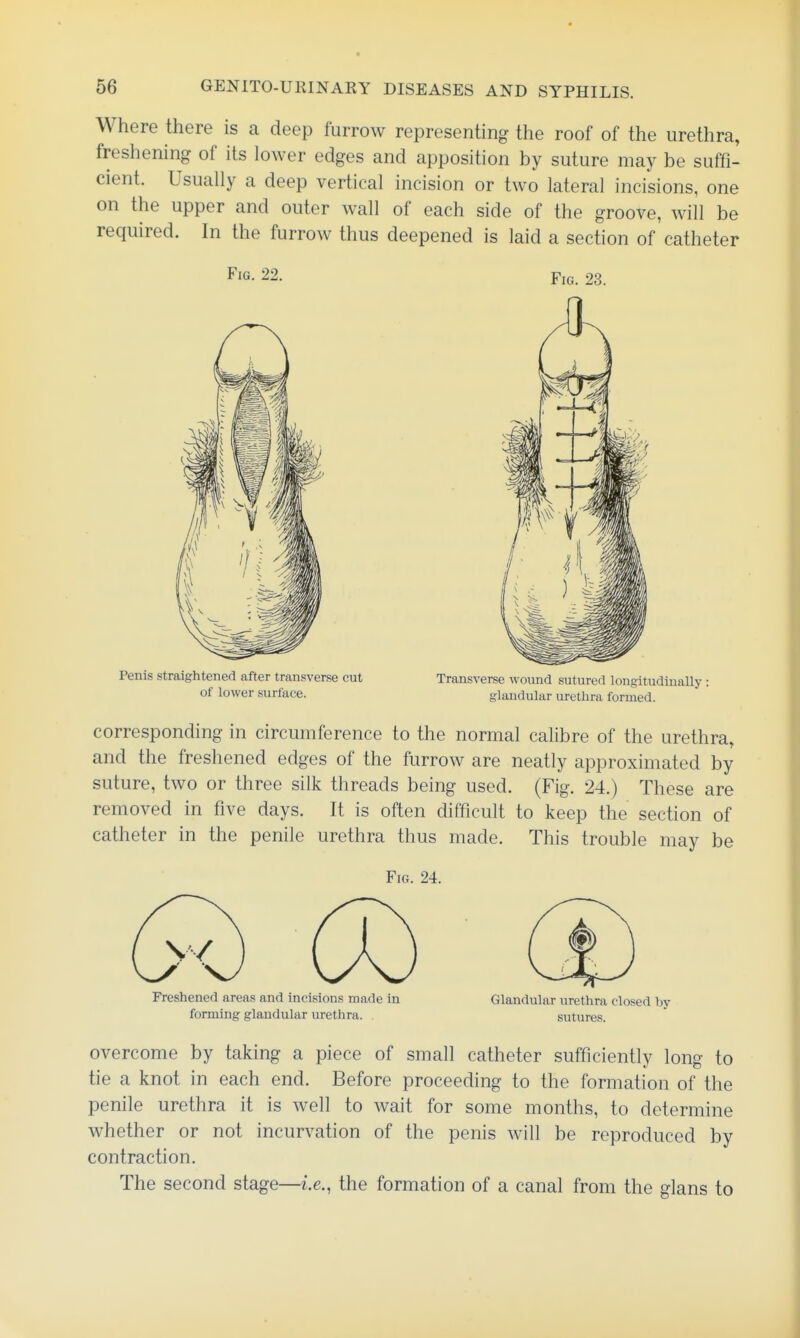 Where there is a deep furrow representing the roof of the urethra, freshening of its lower edges and apposition by suture may be suffi- cient. Usually a deep vertical incision or two lateral incisions, one on the upper and outer wall of each side of the groove, will be required. In the furrow thus deepened is laid a section of catheter Fig. 22. Pic. 23. Penis straightened after transverse cut Transverse wound sutured longitudiuaUy : of lower surface. glandular urethra formed. corresponding in circumference to the normal calibre of the urethra, and the freshened edges of the furrow are neatly approximated by suture, two or three silk threads being used. (Fig. 24.) These are removed in five days. It is often difficult to keep the section of catheter in the penile urethra thus made. This trouble may be Fig. 24. Freshened areas and incisions made in Glandular urethra closed by forming glandular urethra. sutures. overcome by taking a piece of small catheter sufficiently long to tie a knot in each end. Before proceeding to the formation of the penile urethra it is well to wait for some months, to determine whether or not incurvation of the penis will be reproduced by contraction. The second stage—i.e., the formation of a canal from the glans to