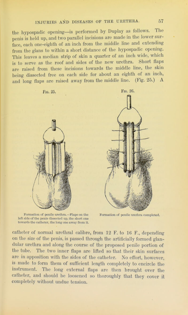 the hypospadic opening—is performed by Duplay as follows. The penis is held up, and two parallel incisions are made in the lower sur- face, each one-eighth of an inch from the middle line and extending from the glans to within a short distance of the hypospadic opening. This leaves a median strip of skin a quarter of an inch wide, which is to serve as the roof and sides of the new urethra. Short flaps are raised from these incisions towards the middle hne, the skin being dissected free on each side for about an eighth of an inch, and long flaps are raised away from the middle line. (Fig. 25.) A Fig. 25. Fig. 26. Formation of penile urethra.—Flaps on the Formation of penile urethra completed, left side of the penis dissected up, the short one towards the catheter, the long one away from it. catheter of normal urethral calibre, from 12 F. to 16 F., depending on the size of the penis, is passed through the artificially formed glan- dular urethra and along the course of the proposed penile portion of the tube. The two inner flaps are lifted so that their skin surfaces are in apposition with the sides of the catheter. No effort, however, is made to form them of sufficient length completely to encircle the instrument. The long external flaps are then brought over the catheter, and should be loosened so thoroughly that they cover it completely without undue tension.