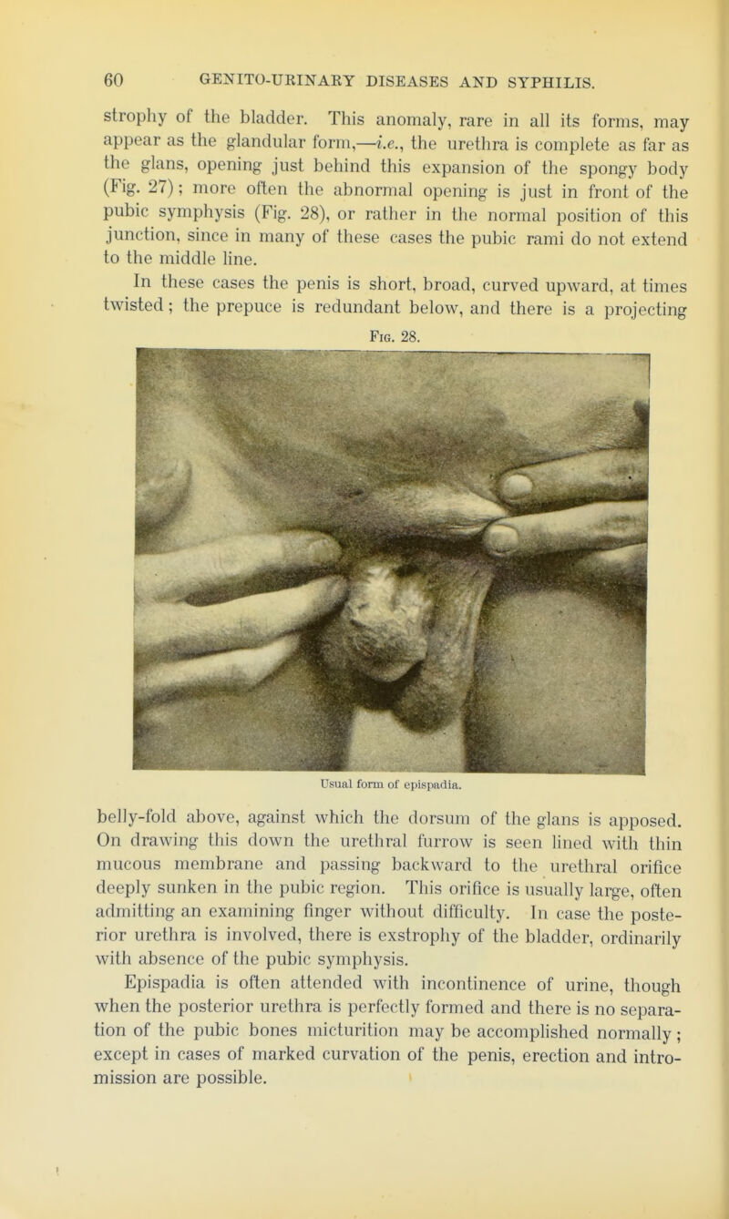 strophy of the bladder. This anomaly, rare in all its forms, may appear as the glandular form,—i.e., the urethra is complete as far as the glans, opening just behind this expansion of the spongy body (Fig. 27); more often the abnormal opening is just in front of the pubic symphysis (Fig. 28), or rather in the normal position of this junction, since in many of these cases the pubic rami do not extend to the middle line. In these cases the penis is short, broad, curved upward, at times twisted; the prepuce is redundant below, and there is a projecting Fin. 2S. Usual form ol upisiiadia. belly-fold above, against which the dorsum of the glans is apposed. On drawing this down the urethral furrow is seen lined with thin mucous membrane and passing backward to the urethral orifice deeply sunken in the pubic region. This orifice is usually large, often admitting an examining finger without difficulty. In case the poste- rior urethra is involved, there is exstrophy of the bladder, ordinarily with absence of the pubic symphysis. Epispadia is often attended with incontinence of urine, though when the posterior urethra is perfectly formed and there is no separa- tion of the pubic bones micturition may be accomplished normally; except in cases of marked curvation of the penis, erection and intro- mission are possible.