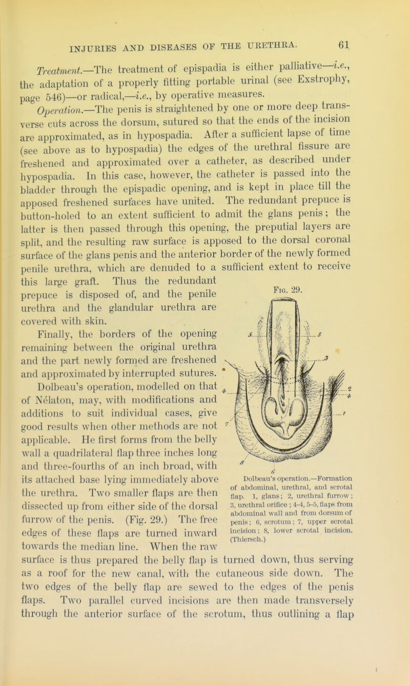 Fig. 29. Treatment—The treatment of epispadia is either palliative—i.e., the adaptation of a properly fitting portable urinal (see Exstrophy, page 546)—or radical—i.e., by operative measures. Operation.—The penis is straightened by one or more deep trans- verse cuts across the dorsum, sutured so that the ends of the incision are approximated, as in hypospadia. After a sufficient lapse of time (see above as to hypospadia) the edges of the urethral fissure are freshened and approximated over a catheter, as described under hypospadia. In this case, however, the catheter is passed into the bladder through the epispadic opening, and is kept in place till the apposed freshened surfaces have united. The redundant prepuce is button-holed to an extent sufficient to admit the glans penis; the latter is then passed through this opening, the preputial layers are split, and the resulting raw surface is apposed to the dorsal coronal surface of the glans penis and the anterior border of the newly formed penile urethra, which are denuded to a sufficient extent to receive this large graft. Thus the redundant prepuce is disposed of, and the penile urethra and the glandular urethra are covered with skin. Finally, the borders of the opening remaining between the original urethra and the part newly formed are freshened and approximated by interrupted sutures. Dolbeau's operation, modelled on that of Nelaton, may, with modifications and additions to suit individual cases, give good results when other methods are not applicable. He first forms from the belly wall a quadrilateral flap three inches long and three-fourths of an inch broad, with its attached base lying immediately above the urethra. Two smaller flaps are then dissected up from either side of the dorsal furrow of the penis. (Fig. 29.) The free edges of these flaps are turned inward towards the median line. When the raw surface is thus prepared the belly flap is turned down, thus serving as a roof for the new canal, with the cutaneous side down. The two edges of the belly flap are sewed to the edges of the penis flaps. Two parallel curved incisions are then made transversely through the anterior surface of the scrotum, thus outlining a flap Dolbeau's operation.—Formation of abdominal, urethral, and scrotal flap. 1, glans; 2, invthral furrow ; 3, urethral orifice ; 4-4, 5-5, flaps from abdominal wall and from dorsum of penis; 6, scrotum; 7, upper scrotal incision; 8, lower scrotal incision. (Thiersch.) }