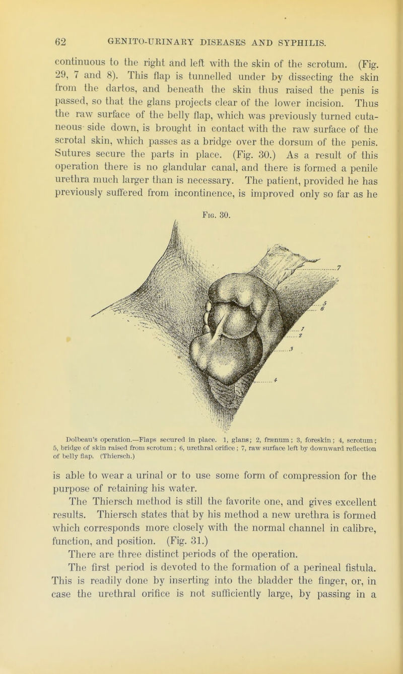 continuous to the right and left with the skin of the scrotum. (Fig. 29, 7 and 8). This flap is tunnelled under by dissecting the skin from the dartos, and beneath the skin thus raised the penis is passed, so that the glans projects clear of the lower incision. Thus the raw surface of the belly flap, which was previously turned cuta- neous side down, is brought in contact with the raw surface of the scrotal skin, which passes as a bridge over the dorsum of the penis. Sutures secure the parts in place. (Fig. 30.) As a result of this operation there is no glandular canal, and there is formed a penile urethra much larger than is necessary. The patient, provided he has previously suffered from incontinence, is improved only so far as he Fig. 30. Dolbeau's operation.—Flaps secured in place. 1, glans; 2, frsenum; 3, foreskin; 4, scrotiun; 5, bridge of skin raised from scrotum ; 6, urethral orifice ; 7, raw surface left by dowTiward reflection of belly flap. (Thiersch.) is able to wear a urinal or to use some form of compression for the purpose of retaining his water. The Thiersch method is still the favorite one, and gives excellent results. Thiersch states that by his method a new urethra is formed which corresponds more closely with the normal channel in calibre, function, and position. (Fig. 31.) There are three distinct periods of the operation. The first period is devoted to the formation of a perineal fistula. This is readily done by inserting into the bladder the finger, or, in case the urethral orifice is not sufficiently large, by passing in a