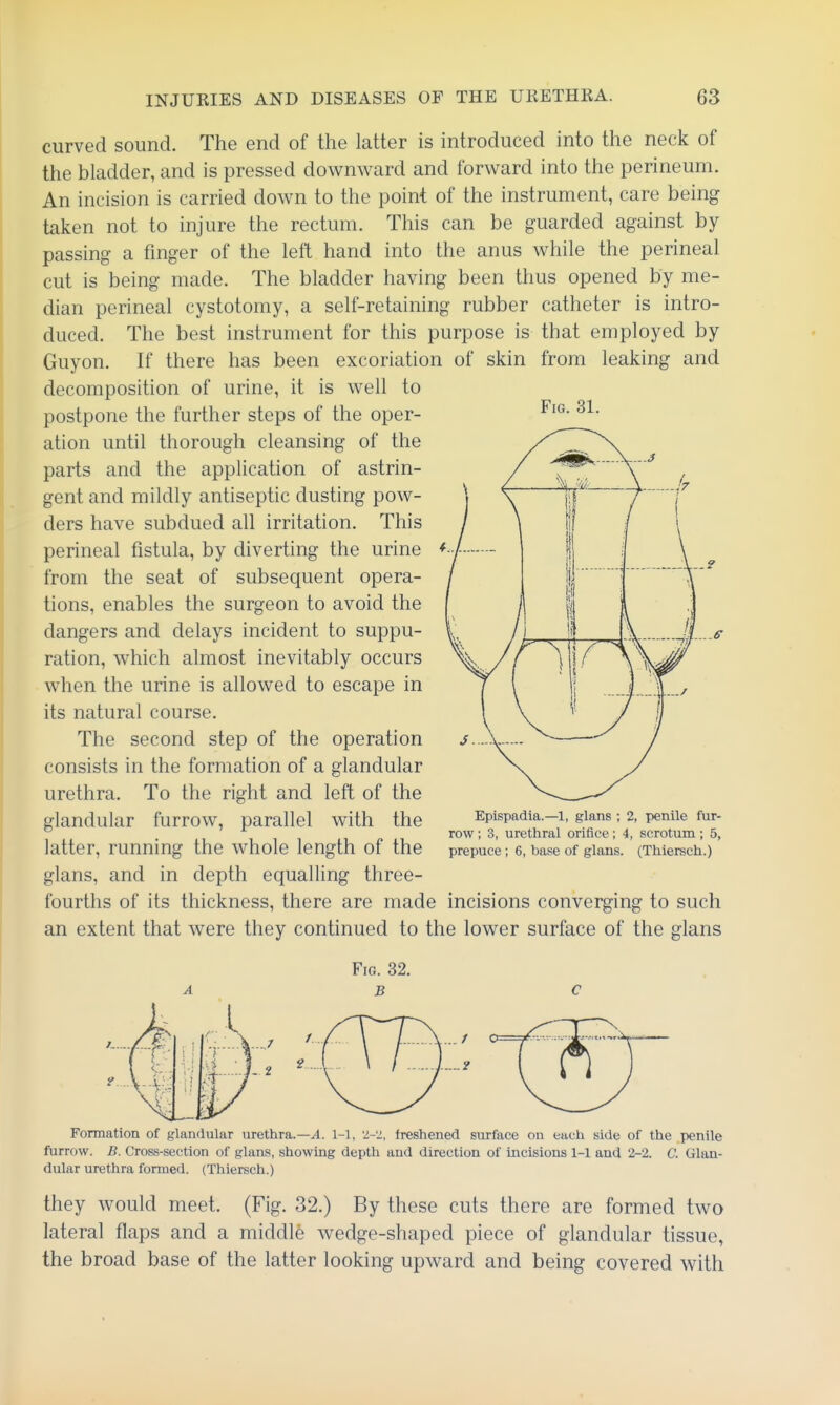 Fig. 31. curved sound. The end of the latter is introduced into the neck of the bladder, and is pressed downward and forward into the perineum. An incision is carried down to the point of the instrument, care being taken not to injure the rectum. This can be guarded against by passing a finger of the left hand into the anus while the perineal cut is being made. The bladder having been thus opened by me- dian perineal cystotomy, a self-retaining rubber catheter is intro- duced. The best instrument for this purpose is that employed by Guyon. If there has been excoriation of skin from leaking and decomposition of urine, it is well to postpone the further steps of the oper- ation until thorough cleansing of the parts and the application of astrin- gent and mildly antiseptic dusting pow- ders have subdued all irritation. This perineal fistula, by diverting the urine from the seat of subsequent opera- tions, enables the surgeon to avoid the dangers and delays incident to suppu- ration, which almost inevitably occurs when the urine is allowed to escape in its natural course. The second step of the operation consists in the formation of a glandular urethra. To the right and left of the glandular furrow, parallel with the latter, running the whole length of the glans, and in depth equalling three- fourths of its thickness, there are made incisions converging to such an extent that were they continued to the lower surface of the glans ...e Epispadia.—1, glans ; 2, penile fur- row ; 3, urethral orifice; 4, scrotum; 5, prepuce; 6, base of glans. (Thiersch.) Fig. 32. B Formation of glandular urethra.—yl. 1-1, 'i-'i, freshened surface on each side of the penile furrow. B. Cross-section of glans, showing depth and direction of incisions 1-1 and 2-2. C. Glan- dular urethra formed. (Thiersch.) they would meet. (Fig. 32.) By these cuts there are formed two lateral flaps and a middle wedge-shaped piece of glandular tissue, the broad base of the latter looking upward and being covered with
