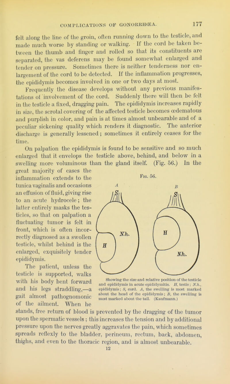 felt along the line of the groin, often running down to the testicle, and made much worse by standing or walking. If the cord be taken be- tween the thumb and finger and rolled so that its constituents are separated, the vas deferens may be found somewhat enlarged and tender on pressure. Sometimes there is neither tenderness nor en- largement of the cord to be detected. If the inflammation progresses, the epididymis becomes involved in one or two days at most. Frequently the disease develops without any previous manifes- tations of involvement of the cord. Suddenly there will then be felt in the testicle a fixed, dragging pain. The epididymis increases rapidly in size, the scrotal covering of the affected testicle becomes oedematous and purplish in color, and pain is at times almost unbearable and of a peculiar sickening quality which renders it diagnostic. The anterior discharge is generally lessened; sometimes it entirely ceases for the time. On palpation the epididymis is found to be sensitive and so much enlarged that it envelops the testicle above, behind, and below in a swelling more voluminous than the gland itself. (Fig. 56.) In the great majority of cases the inflammation extends to the tunica vaginalis and occasions an effusion of fluid, giving rise to an acute hydrocele; the latter entirely masks the tes- ticles, so that on palpation a fluctuating tumor is felt in front, which is often incor- rectly diagnosed as a swollen testicle, whilst behind is the enlarged, exquisitely tender epididymis. The patient, unless the testicle is supported, walks with his body bent forward and his legs straddling,—a gait almost pathognomonic of the ailment. When he stands, free return of blood is prevented by the dragging of the tumor upon the spermatic vessels; this increases the tension and by additional pressure upon the nerves greatly aggravates the pain, which sometimes spreads reflexly to the bladder, perineum, rectum, back, abdomen, thighs, and even to the thoracic region, and is almost unbearable. 12 Fig. 56. Showing the size and relative position of the testicle and epididymis in acute epididymitis. H, testis; N.h., epididymis; S, cord. A, the swelling is most marked about the head of the epididymis; B, the swelling is most marked about the tail. (Kaufmann.)