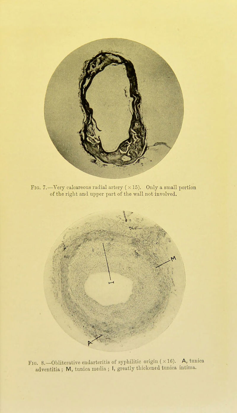 Fig. 8.—Oblitcralivc cudartoiilis of syphilitic origin ( x IC). A, tunica advcntitia ; M, tunica media ; I, greatly tliickcued tunica iutinia.