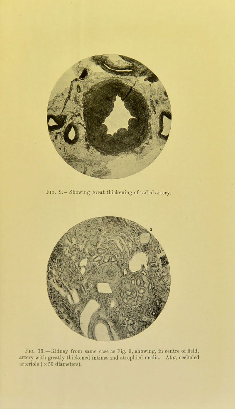 Fig. 9.— Showing great thickening of radial artery. Fig. 10.—Kidney from same case as Fig. 9, showing, in centre of field, artery witli gri^-itly thickened intinia and atrophied media. At a, occluded arteriole ( x 50 diameters).