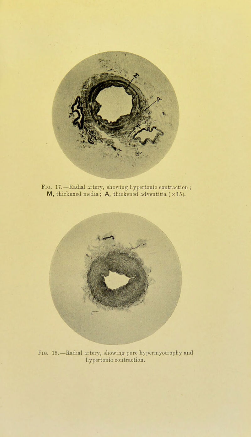 Fig. is.—Radial artoiy, showing pure liypermyotrophy and hypertonic contraction.