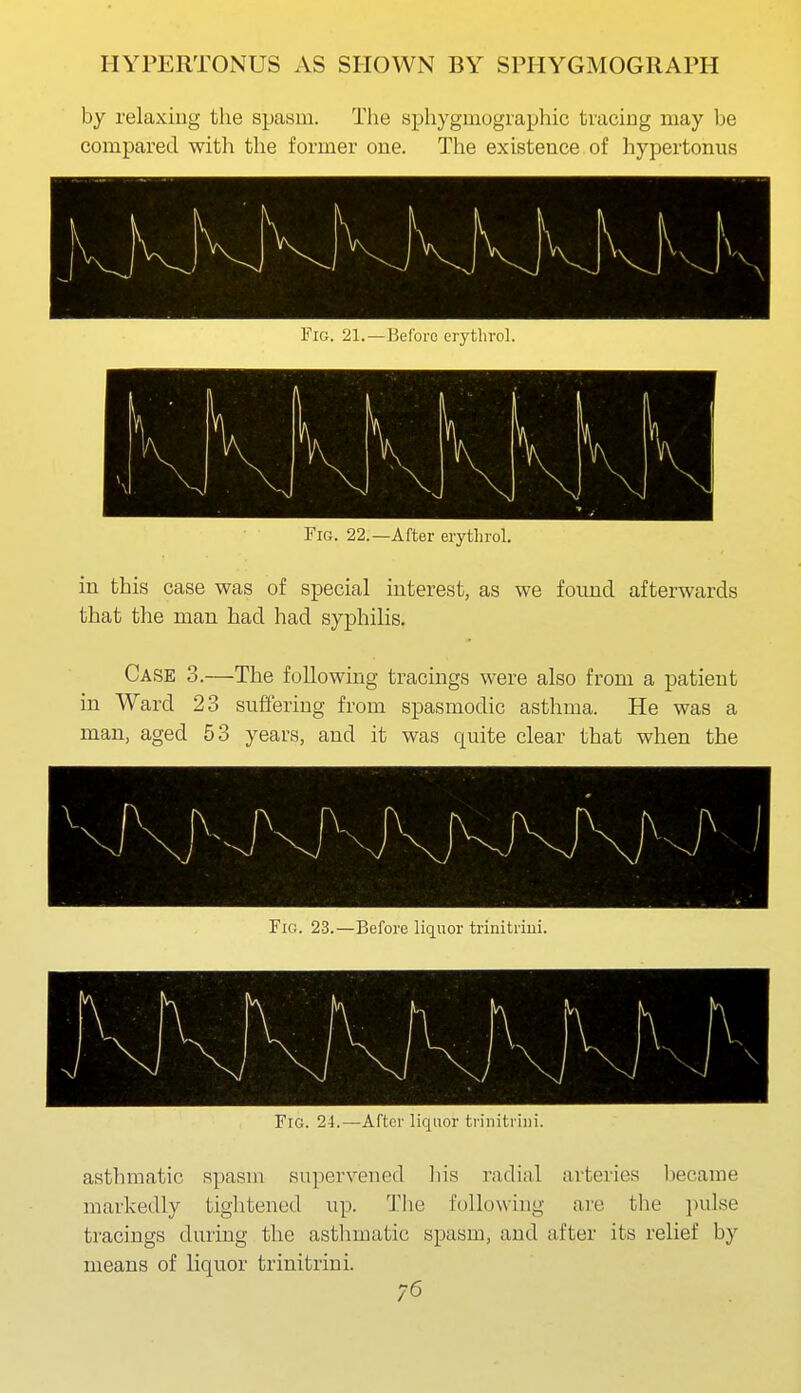 by relaxing the spasm. The sphygmographic tracing may be compared with the former one. The existence of hypertonias Fig. 21.—Before erythrol. Fig. 22.—After erythrol. in this case was of special interest, as we found afterwards that the man had had syphilis. Case 3.—The following tracings were also from a patient in Ward 23 suffering from spasmodic asthma. He was a man, aged 53 years, and it was quite clear that when the V V/ Fig. 23.—Before liquor triuitriiii. X 1 1 ■ ■ 1 1 1 \ \ Fig. 2-1.—After liquor trinitriiii. asthmatic spasm supervened liis radi;il arteries liecame markedly tightened up. Tlie following are the ]nilse tracings during the asthmatic spasm, and after its relief by means of liquor trinitrini.