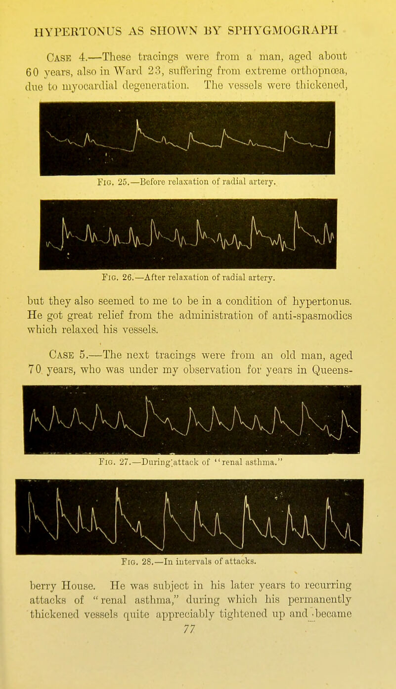 Case 4.—These tracings were from a man, aged about 60 years, also in Ward 23, suffering from extreme orthopnoea, due to myocardial degouoration. The vessels were thickened, Fig. 25.—Before relaxation of radial artery. Fig. 26.—After relaxation of radial artery. but they also seemed to me to be in a condition of hypertonus. He got great relief from the administration of anti-spasmodics which relaxed his vessels. Case 5.—The next tracings were from an old man, aged 70 years, who was under my observation for years in Queens- KKKKj vJVi Fig. 27.—During'.attack of  renal asthma. \ \ I K V Fig. 28.—In intervals of attacks. berry House. He was subject in his later years to recurring attacks of renal asthma, during which his permanently thickened vessels quite appreciably tightened up and -became