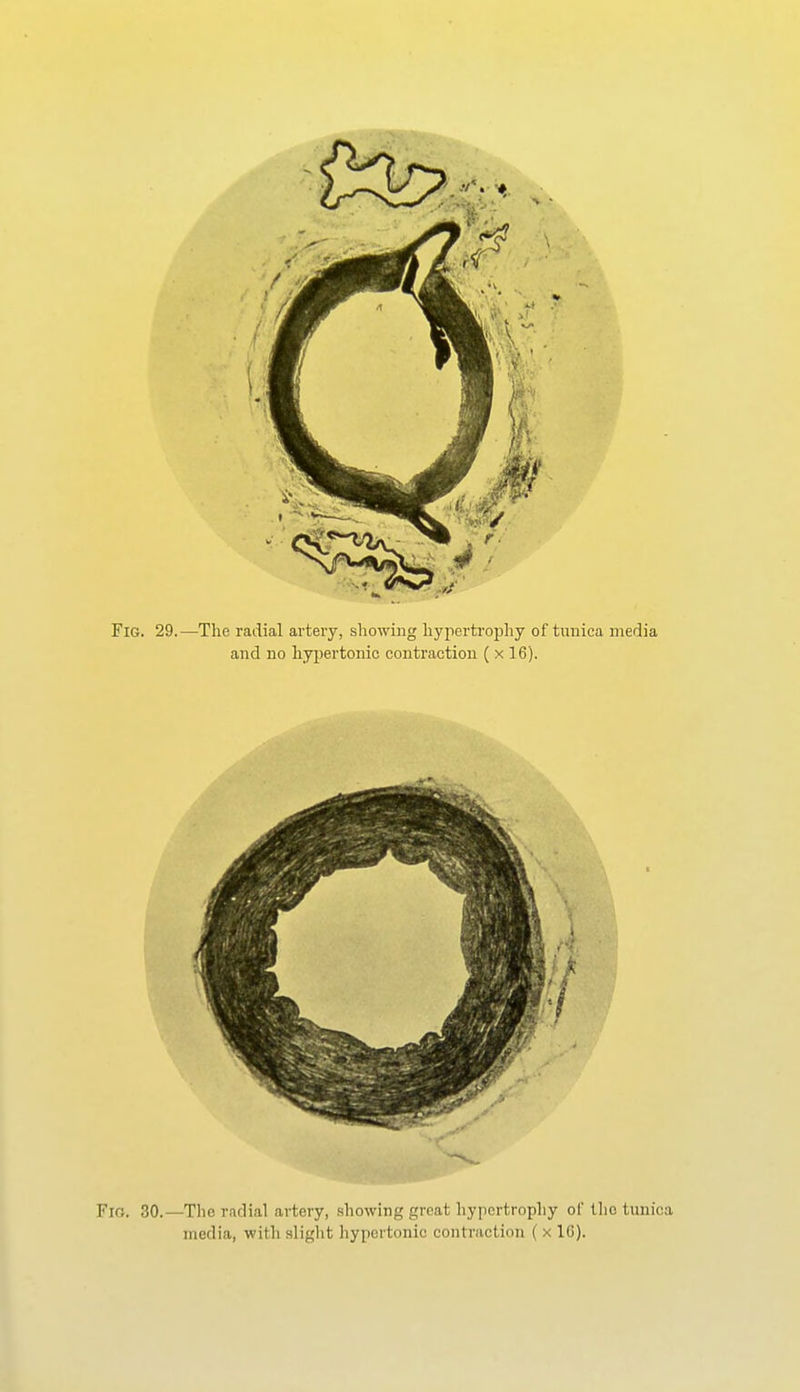 Fig. 30.—The radial artery, showing great liypertropliy of tlio tunica media, with slight hypertonic contraction ( x IC).
