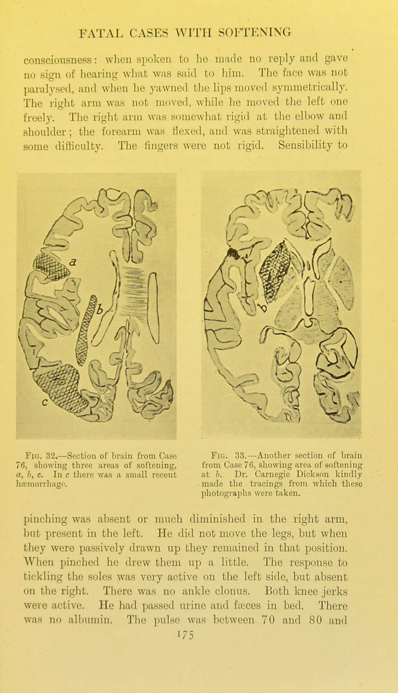 FATAL CASES WITH SOFTENING consciousness: wlieu spoken to he made no reply and gave no sign of lieaving wliat was said to him. Tiic face was not paralysed, and when he yawned tlie lips moved symmetrically. The right arm was not moved, while he moved the left one freely. The right arm was somewhat rigid at the elbow and shoulder; the forearm was flexed, and was straightened with some difficulty. The fingers were not rigid. Sensibility to Fio. 32.—Section of brain from Case 76, showing three areas of softening, a, b, c. In c there was a small recent hfemorrhag(!. Fig. 33.—Another section of brain from Case 76, showing area of softening at h. Dr. Carnegie Dickson kindly made the tracings from which tliese photographs were taken. pinching was absent or much diminished in the right arm, but present in the left. He did not move the legs, but when they were passively drawn up they remained in that position. When pinched he drew them up a little. The response to tickling the soles was very active on the left side, but absent on the right. There was no ankle clonus. Both knee jerks were active. He had passed urine and ficces in bed. There was no albumin. The pulse was between 70 and 80 and 1/5