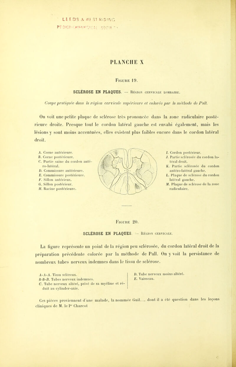 ■ Li ros & n\ SI RiniNc. PLANCHE X Figure 19. SCLÉROSE EN PLAQUES. — Région cervicale lombaire. Coupe pratiquée dans la région cervicale supérieure et colorée par la méthode de Pall. On voit une petite plaque de sclérose très prononcée dans la zone radiculaire posté- rieure droite. Presque tout le cordon latéral gauche est envahi également, mais les lésions y sont moins accenluées, elles existent plus faihles encore dans le cordon latéral droit. A. Coi'ne antérieure. B. Corne postérieure. C. Partie saine du cordon anté ro-latéral. D. Commissure antérieure. E. Commissure postérieure. F. Sillon antérieur. G. Sillon postérieur. H. Racine postérieure. I. Cordon postérieur. J. Partie sclérosée du cordon la- téral droit. K. Partie sclérosée du cordon antéro-latéral gauche. L. Plaque de sclérose du cordon latéral gauche. M. Plaque de sclérose de la zone radiculaire. Figure 20. SCLÉROSE EN PLAQUES. Région cervicale La figure représente un point de la région peu sclérosée, du cordon latéral droit de la préparation précédente colorée par la méthode de Pall. On y voit la persistance de nomhreux tubes nerveux indemnes dans le tissu de sclérose. A-A-A. Tissu scléreux. B-D-B. Tubes nerveux indemnes. C. Tube nerveux altéré, privé de sa myéline et ré- duit au cylinder-axis. D. Tube nerveux moins altéré. E. Vaisseau. Ces pièces proviennent d'une malade, la nommée Guil..., dont il a été question dans les leçons