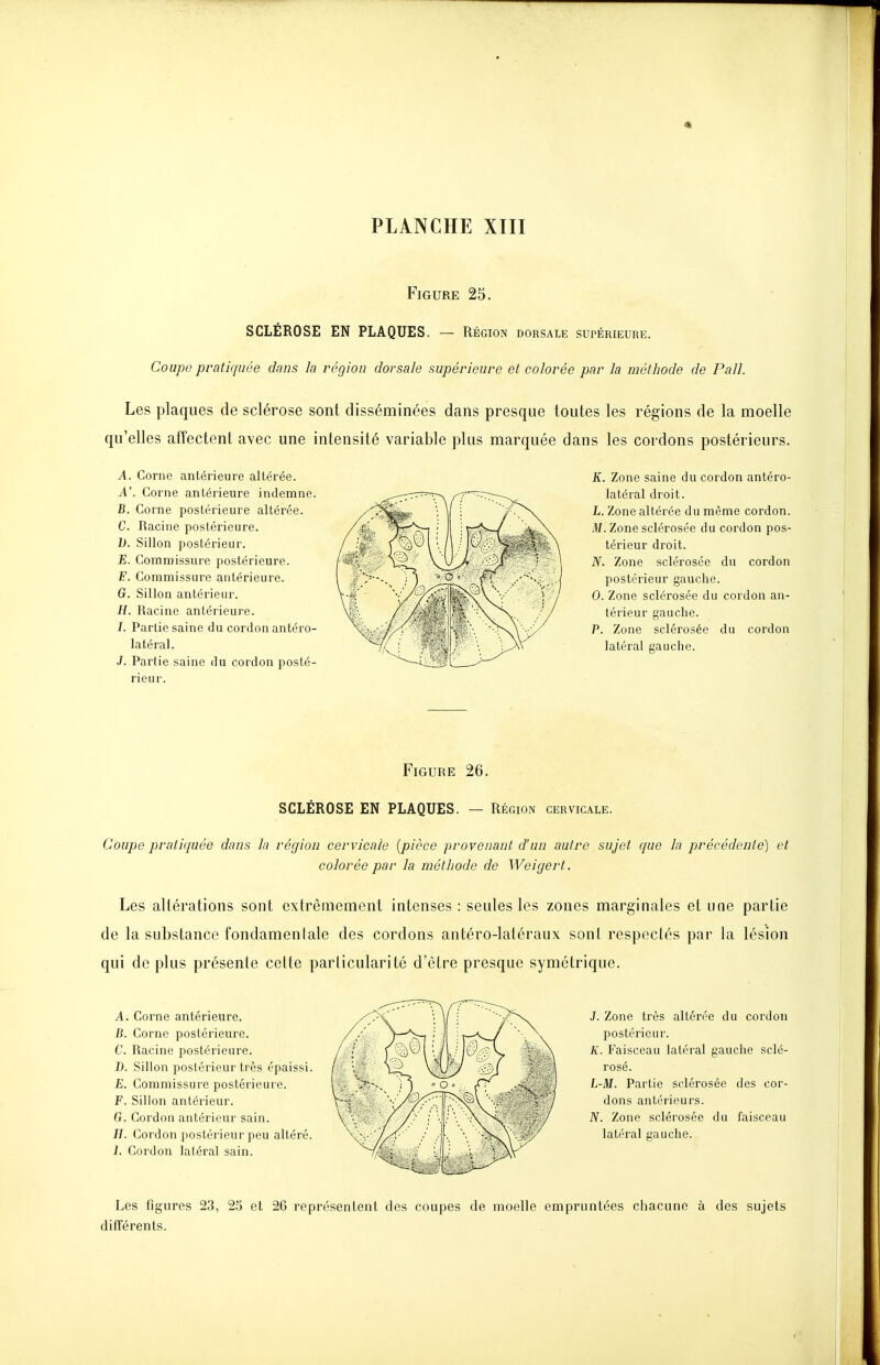 Figure 25. SCLÉROSE EN PLAQUES. — Région dorsale supérieure. Coupe pratiquée dans la région dorsale supérieure et colorée par la méthode de Pall. Les plaques de sclérose sont disséminées dans presque toutes les régions de la moelle qu'elles affectent a^ec une intensité variable plus marquée dans les cordons postérieurs. A. Corne antérieure altérée. A\ Corne antérieure indemne. B. Corne postéiùeure altérée. C. Racine postérieure. h. Sillon postérieur. E. Commissure postérieure. F. Commissure antérieure. G. Sillon antérieur. H. Racine antérieure. I. Partie saine du cordon antéro- latéral. J. Partie saine du cordon posté- rieur. Figure 26. SCLÉROSE EN PLAQUES. — Région cervicale. Coupe pratiquée dans la région cervicale {pièce provenant d'un autre sujet que la précédente) et colorée par la méthode de Weigert. Les altérations sont extrêmement intenses : seules les zones marginales et une partie de la substance fondamentale des cordons antéro-latéraux sont respectés par la lésion qui de plus présente cette particularité d'être presque symétrique. A. Corne antérieure. B. Corne postérieure. C. Racine postérieure. D. Sillon postérieur très épaissi E. Commissure postérieure. F. Sillon antérieur. G. Cordon antérieur sain. IJ. Cordon postérieur peu altéré 1. Cordon latéral sain. Les figures 23, 25 et 26 représentent des coupes de moelle empruntées chacune à des sujets différents. K. Zone saine du cordon antéro- latéral droit. L. Zone altérée du même cordon. M. Zone sclérosée du cordon pos- térieur droit. JV. Zone sclérosée du cordon postérieur gauche. 0. Zone sclérosée du cordon an- térieur gauche. P. Zone sclérosée du cordon latéral gauche. J. Zone très altérée du cordon postérieur. A'. Faisceau latéral gauche sclé- rosé. L-M. Partie sclérosée des cor- dons antérieurs. JV. Zone sclérosée du faisceau latéral gauche.