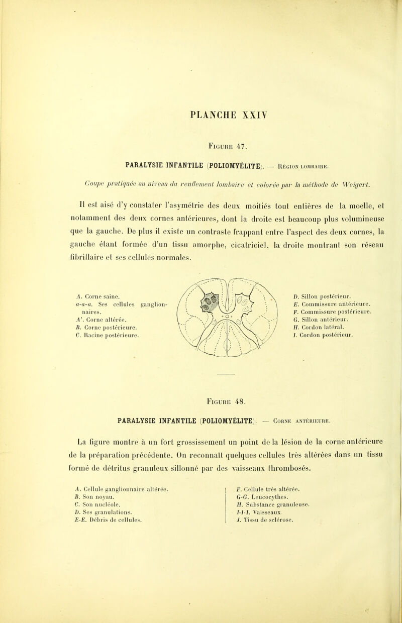 Figure 47. PARALYSIE INFANTILE (POLIOMYÉLITE;. — Région lombaire. Coupe pratiquée au niveau du renflement lomJjaire et colorée par la méthode de Weigert. Il est aisé d'y constater l'asymétrie des deux moitiés tout entières de la moelle, et notamment des deux cornes antérieures^ dont la droite est beaucoup plus volumineuse que la gauche. De plus il existe un contraste frappant entre l'aspect des deux cornes, la gauche étant formée d'un tissu amorphe, cicatriciel, la droite montrant son réseau fibrillaire et ses cellules normales. A. Corne saine. a-a-a. Ses cellules ganglion- naires. A'. Corne altérée. B. Corne postérieure. C. Racine postérieure. D. Sillon postérieur. E. Commissure antérieure. F. Commissure postérieure. G. Sillon antérieur. E. Cordon latéral. 1. Cordon postérieur. Figure 48. PARALYSIE INFANTILE (POLIOMYÉLITE) Corne antérieure. La figure montre à un fort grossissement un point de la lésion de la corne antérieure de la préparation précédente. On reconnaît quelques cellules très altérées dans un tissu formé de détritus granuleux sillonné par des vaisseaux thrombosés. A. Cellule ganglionnaire altérée. B. Son noyau. C. Son nucléole. E-E. Débris de cellules. F. Cellule très altérée. G-G. Leucocythes. H. Substance granuleuse. I-l-I. Vaisseaux J. Tissu de sclérose.