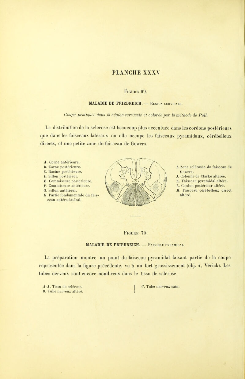 Figure 69. MALADIE DE FRIEDREICH. — Région cervicale. Coupe pratiquée dans la région cervicale et colorée par la métîiode de Pall. La distribution de la sclérose est beaucoup plus accentuée dans les cordons postérieurs que dans les faisceaux latéraux où elle occupe les faisceaux pyramidaux, cérébelleux directs, et une petite zone du faisceau de Gowers. A. Corne antérieure, if. Corne postérieure. C. Racine postérieure. D. Sillon postérieur. E. Commissure postérieure. F. Commissure antérieure. G. Sillon antérieur. H. Partie fondamentale du fais- ceau autéro-latéral. 1. Zone sclérosée du faisceau de Gowers. J. Colonne de Clarke altérée. K. Faisceau pyramidal altéi'é. L. Cordon postérieur altéré. M. Faisceau cérébelleux direct altéré. Figure 70. MALADIE DE FRIEDREICH. — Faisceau pyramidal. La préparation montre un point du faisceau pyramidal faisant partie de la coupe représentée dans la figure précédente, vu à un fort grossissement (obj. 4, Vérick). Les tubes nerveux sont encore nombreux dans le tissu de sclérose. A-A. Tissu de sclérose. [ C. Tube nerveux sain. C. Tube nerveux altéré. !