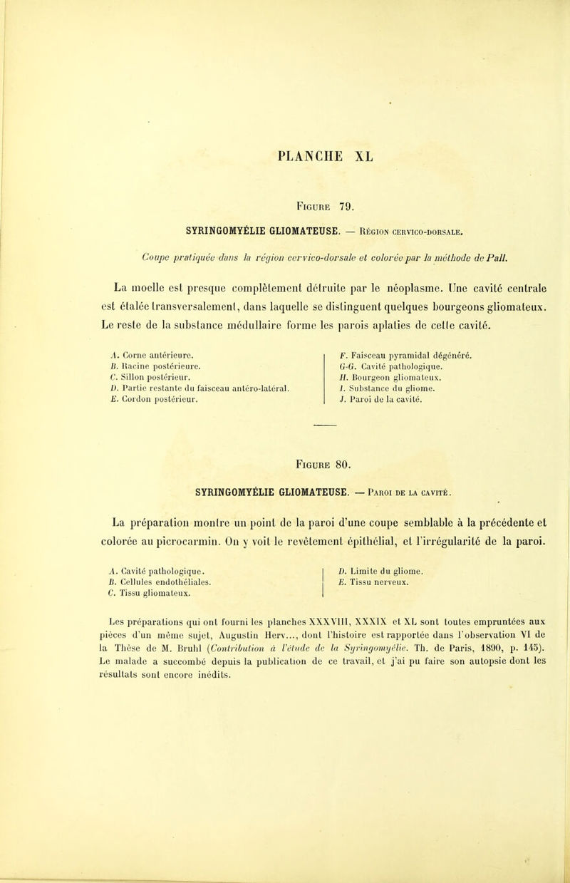 Figure 79. SYRINGOMYÉLIE GLIOMATEUSE. — Région cervico-dorsale. Coupe pratiquée dans la région cevvico-dovsaîe et colorée par la méthode do Pall. La moelle est presque complètement détruite par le néoplasme. Une cavité centrale est étalée transversalement, dans laquelle se distinguent quelques bourgeons gliomateux. Le reste de la substance médullaire forme les parois aplaties de celle cavité. A. Corne antérieure. jB. Racine postérieure. C. Sillon postérieur. D. Partie restante du faisceau antéro-latéral. E. Cordon postérieur. F. Faisceau pyramidal dégénéré. G-G. Cavité pathologique. H. Bourgeon gliomateux. I. Substance du gliome. J. Paroi de la cavité. Figure 80. SYRINGOMYÉLIE GLIOMATEUSE. — Paroi de la cavité. La préparation montre un point de la paroi d'une coupe semblable à la précédente et colorée au picrocarmin. On y voit le revêtement épithélial, et l'irrégularité de la paroi. A. Cavité pathologique. 1 B. Limite du gliome. B. Cellules endothéliales. E. Tissu nerveux. C. Tissu gliomateux. | Les préparations qui ont fourni les planches XXXVIII, XXXIX et XL sont toutes empruntées aux pièces d'un même sujet, Augustin Herv..., dont l'histoire est rapportée dans l'observation VI de la Thèse de M. Bruhl [Contribution à l'élude de la Syringomyélie. Th. de Paris, 1890, p. 145). Le malade a succombé depuis la publication de ce travail, et j'ai pu faire son autopsie dont les résultats sont encore inédits.