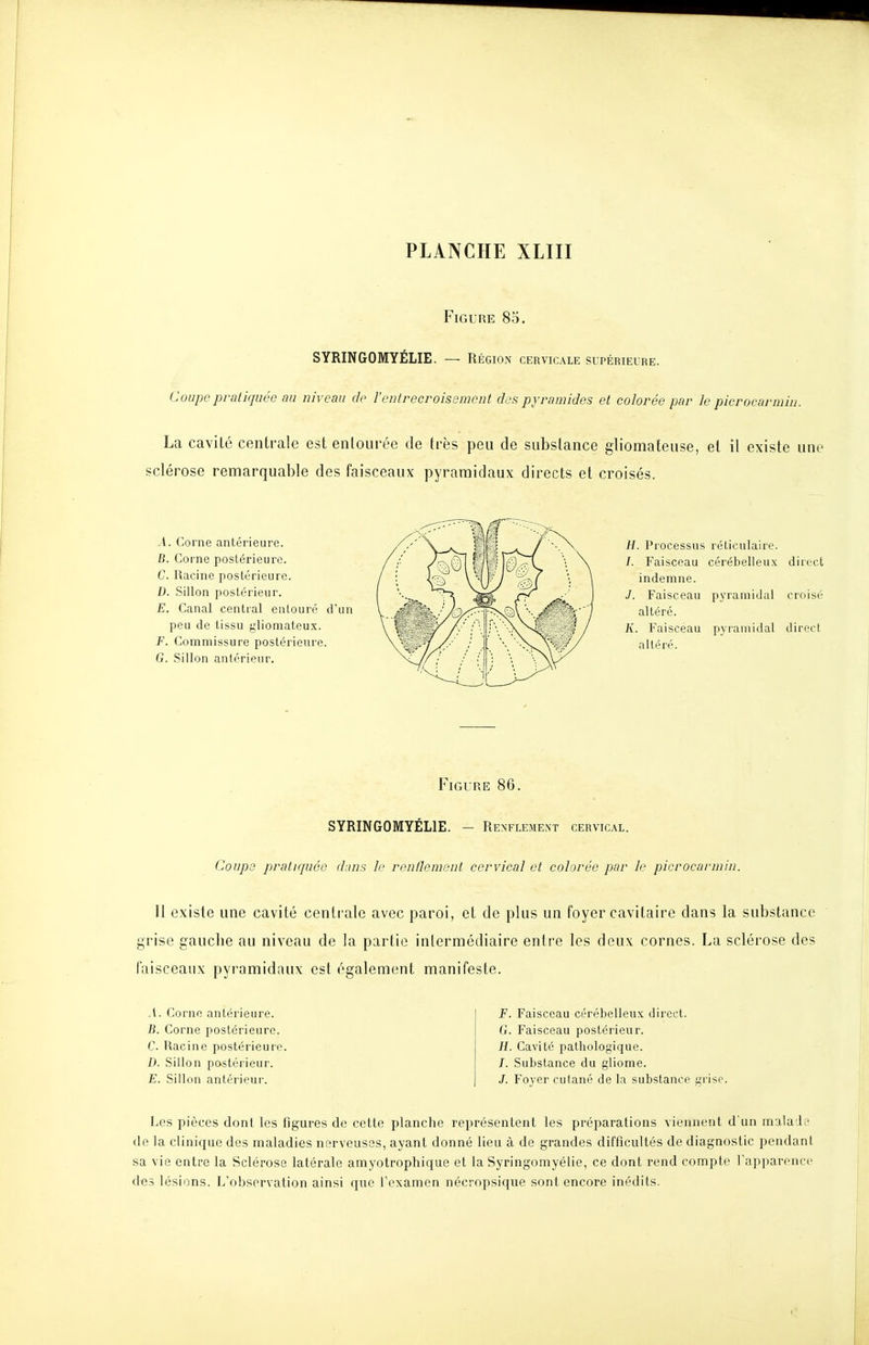 Figure 85. SYRINGOMYÉLIE. — Région cervicale supérieure. Coupe pratiquée au niveau de l'entrecroisement des pyramides et colorée par le picrocarmin. La cavité centrale est entourée de très peu de substance gliomateuse, et il existe une sclérose remarquable des faisceaux pyramidaux directs et croisés. A. Corne antérieure. B. Corne postérieure. C. Racine postérieure. D. Sillon postérieur. E. Canal central entouré d'un peu de tissu gliomateux. F. Commissure postérieure. G. Sillon antérieur. H. Processus réticulaire. /. Faisceau cérébelleux direct indemne. J. Faisceau pyramidal croisé altéré. K. Faisceau pyramidal direct altéré. Figure 86. SYRINGOMYÉLIE. - Renflement cervical. Coups pratiquée dans le renllemenl cervical et colorée par le picrocarmin. Il existe une cavité centrale avec paroi, et de plus un foyer cavitaire dans la substance grise gauche au niveau de la partie intermédiaire entre les deux cornes. La sclérose des faisceaux pyramidaux est également manifeste. A. Corne antérieure. B. Corne postérieure. C. Racine postérieure. D. Sillon postérieur. E. Sillon antérieur. E. Faisceau cérébelleux direct. G. Faisceau postérieur. H. Cavité pathologique. /. Substance du gliome. J. Fover cutané de la substance grise. I-.es pièces dont les figures de cette planche représentent les préparations viennent dun malade de la clinique des maladies nerveuses, ayant donné lieu à de grandes difficultés de diagnostic pendant sa vie entre la Sclérose latérale amyotrophique et la Syringomyélie, ce dont rend compte l'apparonce des lésions. L'observation ainsi que l'examen nécropsique sont encore inédits.