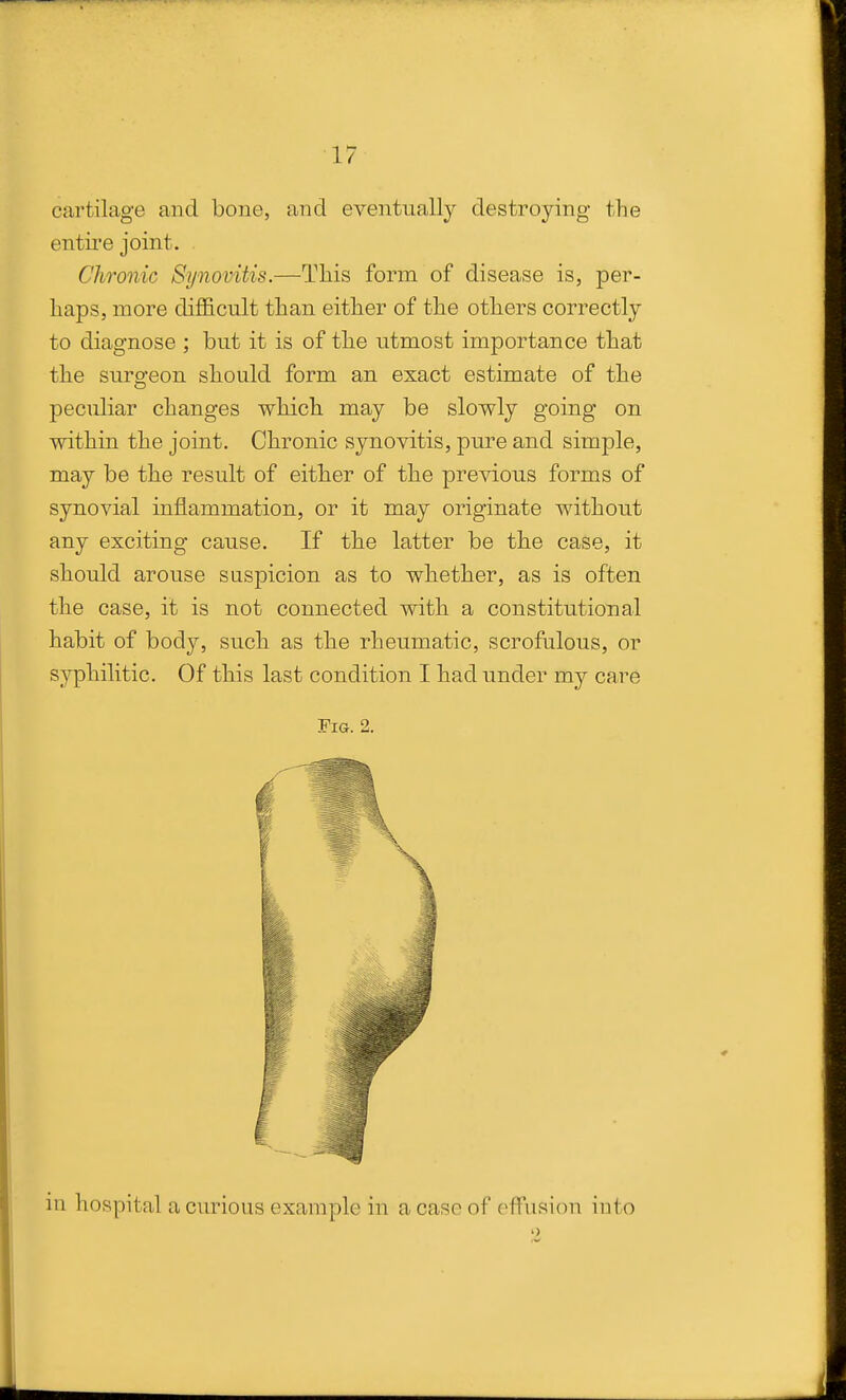 cartilage and bone, and eventually destroying the entire joint. Chronic Sijnovitis.—This form of disease is, per- haps, more diflScult than either of the otliers correctly to diagnose ; but it is of the utmost importance that the surgeon should form an exact estimate of the peculiar changes which may be slowly going on within the joint. Chronic synovitis, pure and simple, may be the result of either of the previous forms of synovial inflammation, or it may originate without any exciting cause. If the latter be the case, it should arouse suspicion as to whether, as is often the case, it is not connected with a constitutional habit of body, such as the rheumatic, scrofulous, or syphilitic. Of this last condition I had under my care Fig. 2. in hospital a curious example in a case of effusion into