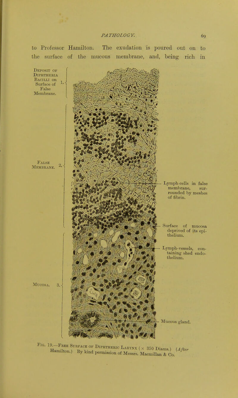 to Professor Hamilton. The exudation is poured out on to the surface of the mucous membrane, and, being rich in Deposit ok DiPHTHEKIA Bacilli on Surface of False Membrane. False j Membkane. • in false , sur- rounded by meshes of fibrin. ®^»<8f?7'^:^^J^'?S'(*>>'i»<-W.i'/^^ Surface of mucosa ^£Mm^sWW^^^^K ¥ <i«Prived of its epi- Mucosa. 3. Lymph-vessels, con- taining shed endo- thelium. Fig. ig^FREE Suu.aoe ok Diphtheuio Lauvn.x ( x 350 Diams.) Ufter Hamilton.) By kind permission of Messrs. Macmillan & Co. ^