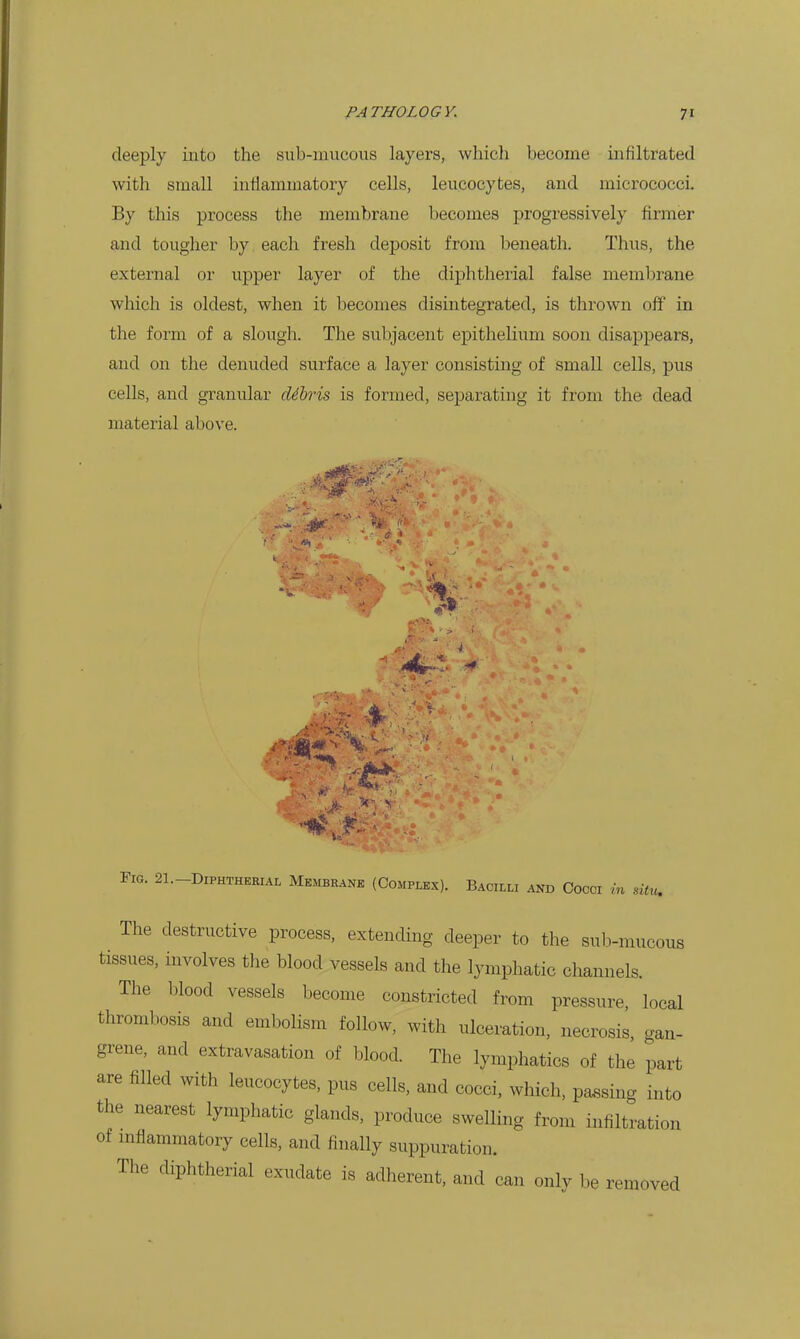 deeply into the sub-mucous layers, which become infiltrated with small inflammatory cells, leucocytes, and micrococci. By this process the membrane becomes progressively firmer and tougher by each fresh dejDosit from beneath. Thus, the external or upper layer of the diphtherial false membrane which is oldest, when it becomes disintegrated, is thrown off in the form of a slough. The subjacent epithelium soon disappears, and on the denuded surface a layer consisting of small cells, pus cells, and granular dihris is formed, separating it from the dead material above. Fig. 21.-D1PHTHERIAL Membrane (Complex). Bacilli and Cocci v. in situ. The destructive process, extending deeper to the sub-mucous tissues, involves the blood vessels and the lymphatic channels. The blood vessels become constricted from pressure, local thrombosis and embolism follow, with ulceration, necrosis, gan- grene, and extravasation of blood. The lymphatics of the part are filled with leucocytes, pus cells, and cocci, which, passing into the nearest lymphatic glands, produce swelling from infiltration of mflammatory cells, and finally suppuration. The diphtherial exudate is adherent, and can only be removed