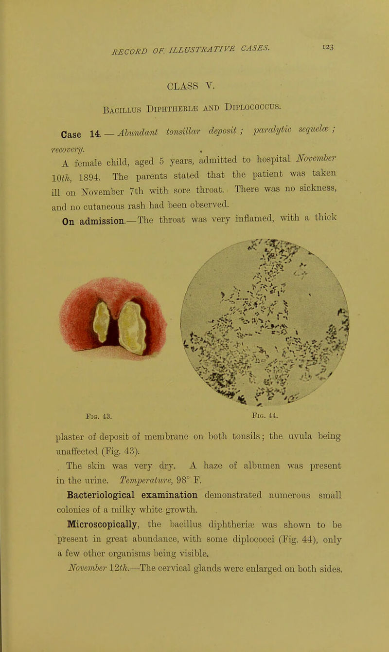 CLASS V. Bacillus DiPHTiiERiiE and Diplococcus. Case — Alxmidant tonsillar deposit; paralytic seqmlce; recovery. A female child, aged 5 years, admitted to hospital November 10th, 1894. The parents stated that the patient was taken ni on November 7th with sore throat. There was no sickness, and no cntaneons rash had been observed. On admission.—The throat was very inflamed, vnth a thick Fig. 43. Fig. 44. plaster of deposit of membrane on both tonsils; the nvula being unaffected (Fig. 43). The skin was very dry. A haze of albumen was present in the urine. Temperature, 98° F. Bacteriological examination demonstrated numerous small colonies of a milky white growth. Microscopically, the bacillus diphtheria was shown to be pi-esent in great abundance, with some diplococci (Fig. 44), only a few other organisms being visible. Novemher 12th.—The cervical glands were enlarged on both sides.