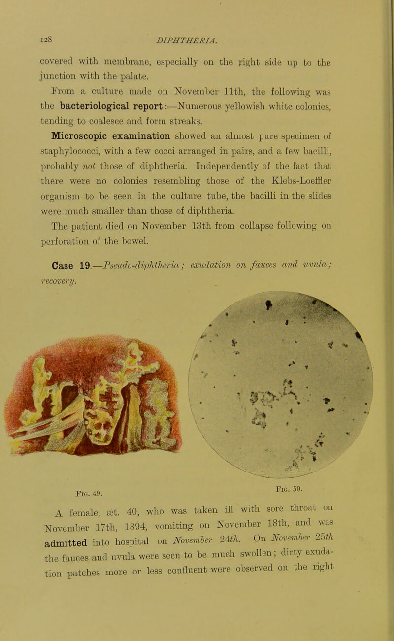 covered with membrane, especially on the right side up to the junction with the palate. From a culture made on November 11th, the following was the bacteriological report:—Numerous yellowish white colonies, tending to coalesce and form streaks. Microscopic examination showed an almost pure specimen of staphylococci, with a few cocci arranged in pairs, and a few bacilli, probably not those of diphtheria. Independently of the fact that there were no colonies resembling those of the Klebs-Loeffler organism to be seen in the culture tube, the bacilli in the slides were much smaller than those of diphtheria. The patient died on November 13th from collapse following on perforation of the bowel. Case 19.—Pseiido-dvphtheria; exiulation on fauces and uvicla; recovery. I* Fig. 49. Fig. 50. A female, eet. 40, who was taken ill with sore throat on November 17th, 1894, vomiting on November 18th, and was admitted into hospital on November 2m. On Novemier 2oth the fauces and uvula were seen to be much swollen; dirty exuda- tion patches more or less confluent were observed on the right