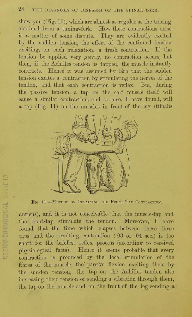 show you (Fig. 10), which are ahnost as regular as the tracing obtained from a tuning-fork. How these contractions arise is a matter of some dispute. They are evidently excited by the sudden tension, the effect of the continued tension exciting, on each relaxation, a fresh contraction. If the tension be applied very gently, no contraction occurs, but then, if the Achilles tendon is tapped, the muscle instantly contracts. Hence it was assumed by Erb that the sudden tension excites a contraction by stimulating the nerves of the tendon, and that each contraction is reflex. But, during the passive tension, a tap on the calf muscle itself will cause a similar contractioii, and so also, I have found, will a tap (Fig. 11) on the muscles in front of the leg (tibialis Fig. 11.—Method of Obtaining the Feont Tap Conteaction. anticus), and it is not conceivable that the muscle-tap and the front-tap stimulate the tendon. Moreover, I have found that the time which elapses between these thi'ee taps and the resulting contraction (-03 or '04 sec.) is too short for the briefest reflex process (according to received physiological facts). Hence it seems j)robable that every contraction is produced by the local stimulation of the fibres of the muscle, the' passive flexion exciting them by the sudden tension, the tap on the Achilles tendon also increasing their tension or sending a vibration through them, the tap on the muscle and on the front of the leg sending a