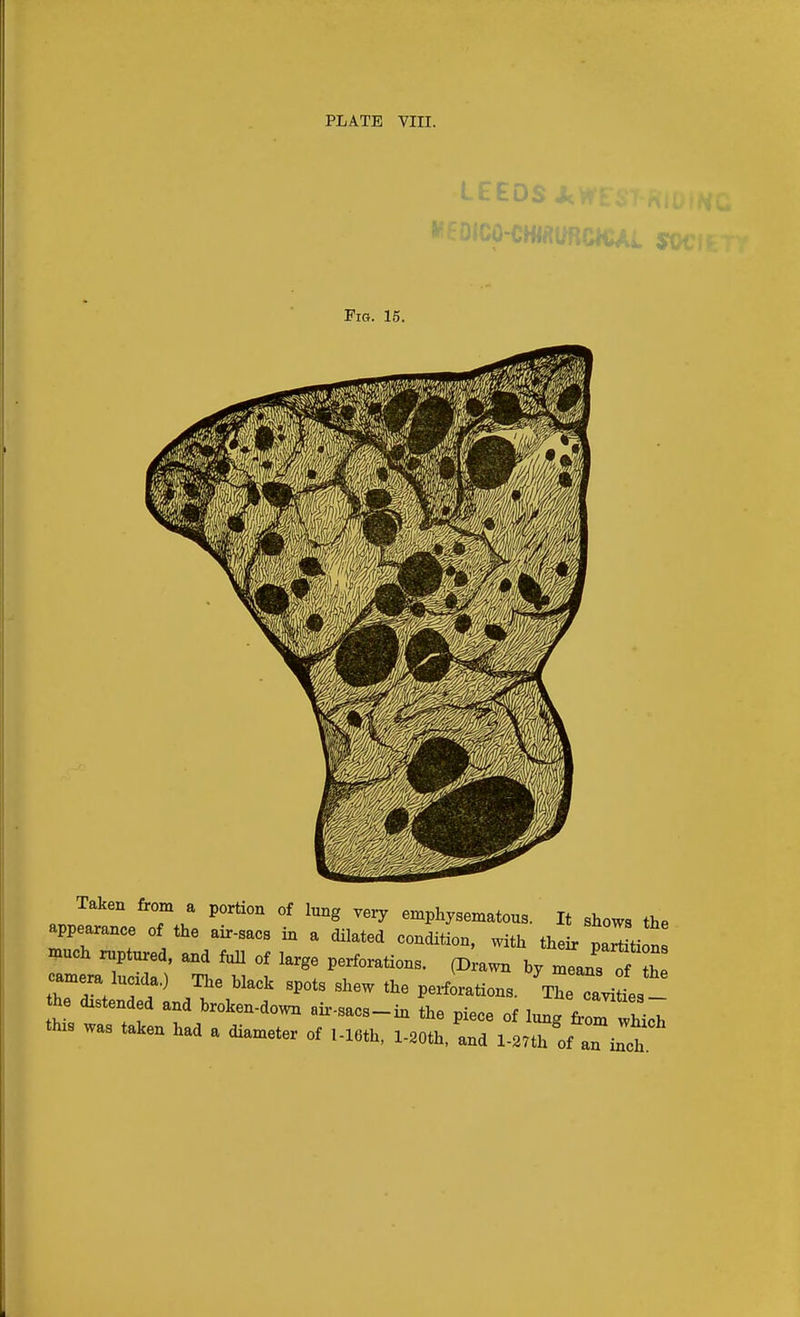 LEEDS ^ Fig. 15. Taken from a portion of lung very emphysematous. It shows the appe-ance of the air-sacs in a dilated condition, with their part ti n much ruptured, and full of large perforations. (Drawn by means o th camera lucida.) The black spots shew the perforations. TTeTji he distended and broken-down air-sacs-in the piece of licT this was taken had a diameter of l-16th, I-20th. and l-27th of an inch