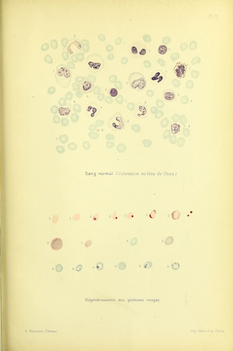 ^9 Sang normal (Coloration au hleu de Unnâ ). .SE; 3 .-v- 6 6 6 » ; 6 6 tf'.^ 6 t Dégénérescence des globules rouges