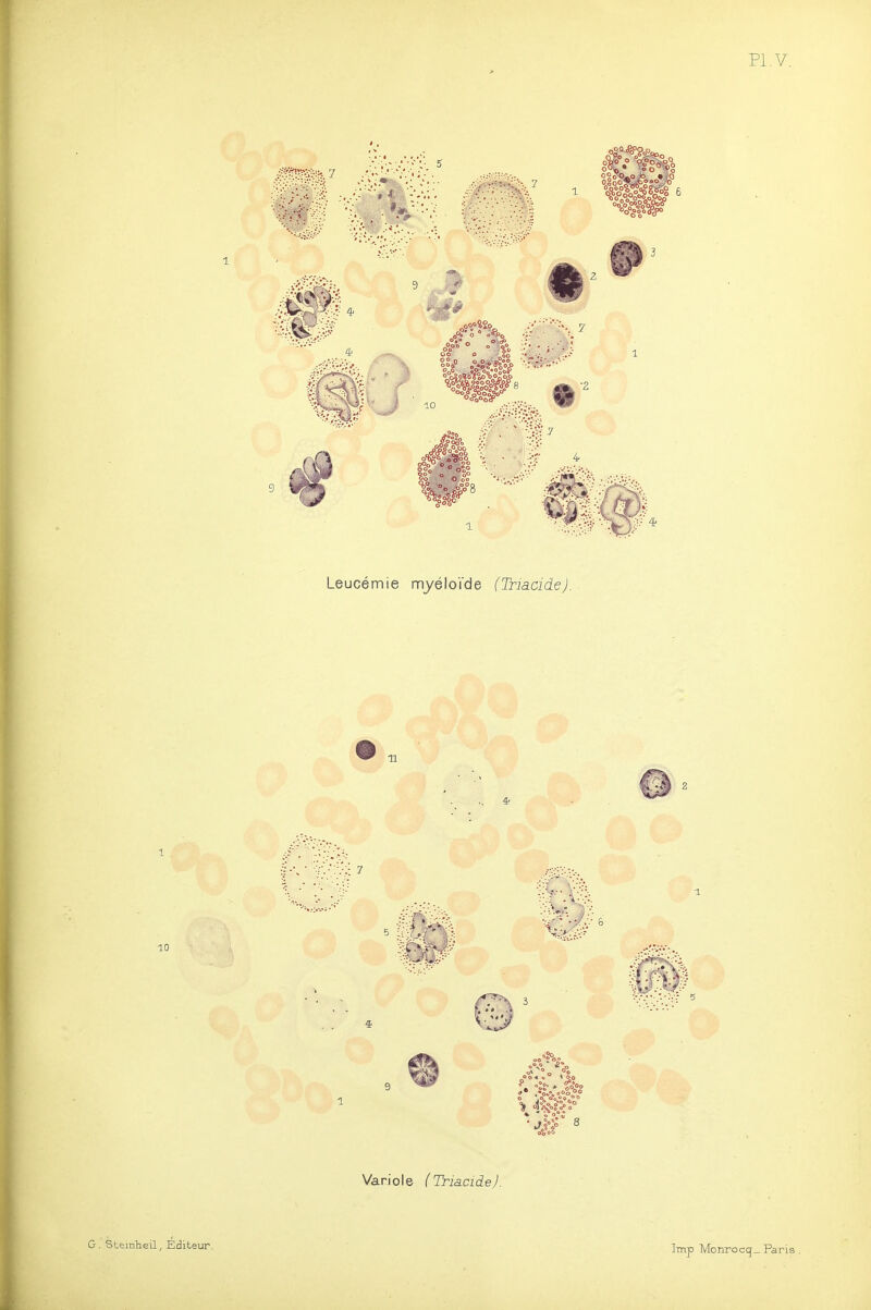 Pl.V. 1 Leucémie myéloi'de (TriacideJ. Variole (TriacideJ.