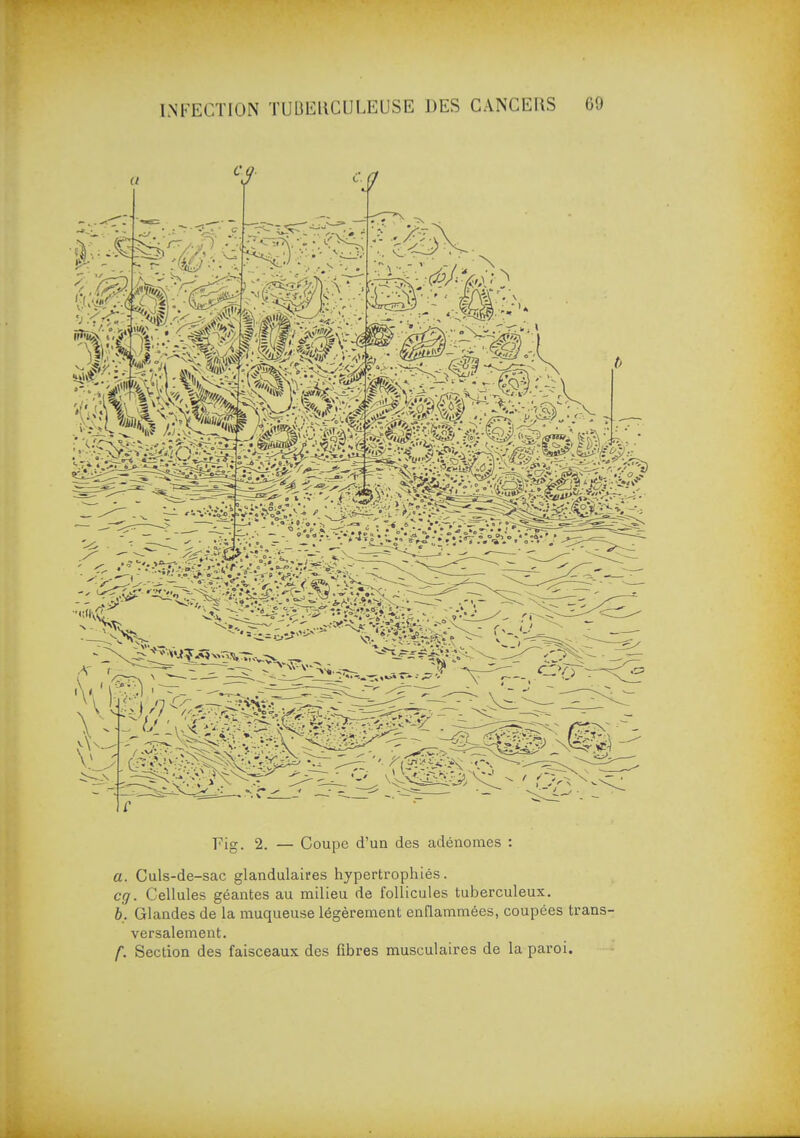 Fig. 2. — Coupe d'un des adénomes : a. Culs-de-sac glandulaires hypertrophiés. cg. Cellules géantes au milieu de follicules tuberculeux. b. Glandes de la muqueuse légèrement ennammées, coupées trans- versalement. f. Section des faisceaux des fibres musculaires de la paroi.