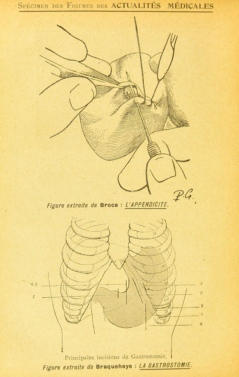 ■SrôciMEN DKs Fir.ruKs DKS ACTUALITÉS MÉDICALES Principales incisions de Gastrostomic. Figure extraite de Braquahaye : LA GASTROSTOMIE.