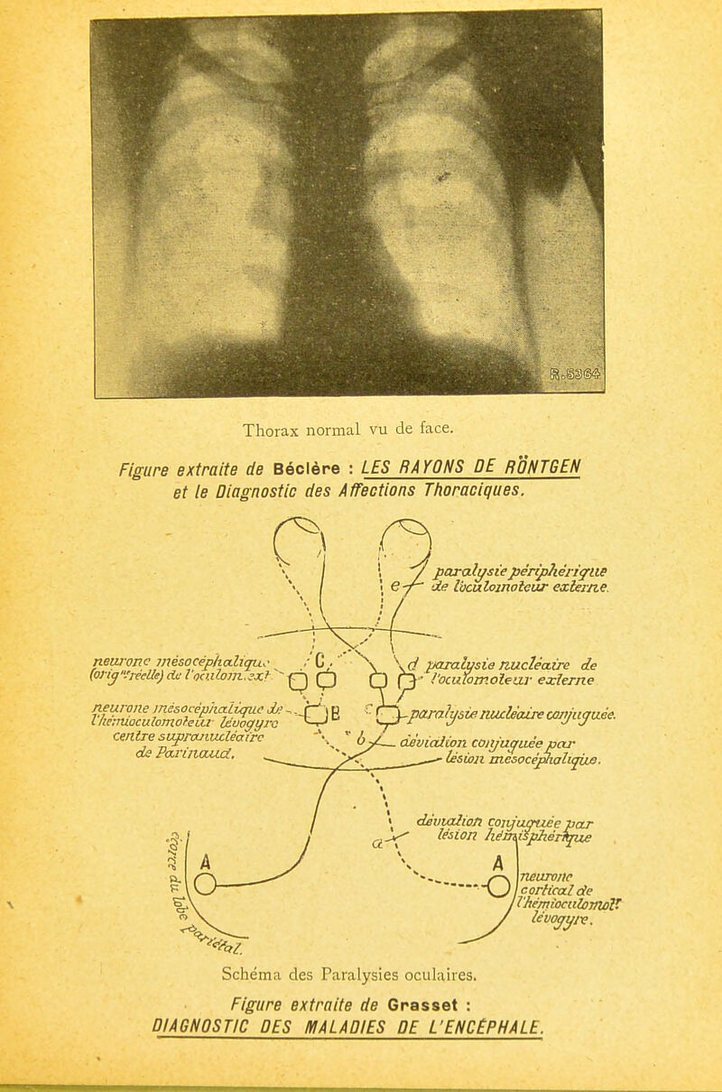 Thorax normal vu de face. Figure extraite de Béclère : LES RAYONS DE RONTGEH et le Diagnostic des Affections Thoraciques. \ y paralysie périphérique \ e-^ de Ivculomoieur exlern.e. nearoTtc jnésocéphcdiqu.' (ori^Vréelle) de Vomlom. ^.tf~ de Paxiiiouià, .■'C/ paralysienuclécdre de cmlTesafrcuiucléafrc -\  b ^ déviaiion conjuyiiéepeu- ■ ié6w2i mcsocéphalijwe. dèvialion coixjumzcepar lésion hémispÂéfibrue A neurone cortical de l'Jtémioculomoî- lévoyyiv. Schéma des Paralysies oculaires. Figure extraite de Grasset : DIAGNOSTIC DES MALADIES DE L'ENCÉPHALE.