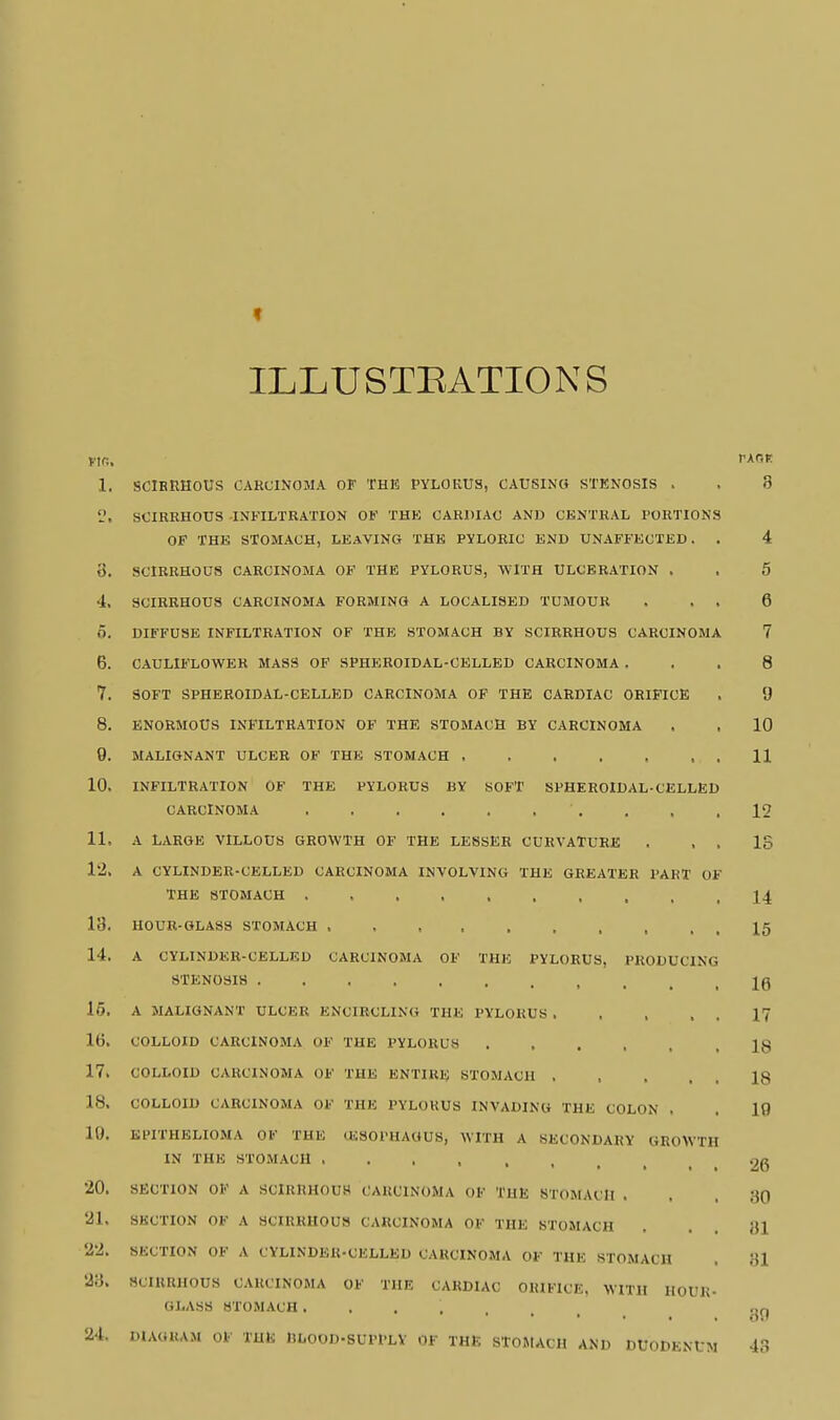 ILLUSTEATIONS Ptfi, rxor. 1. SClBnHOUS CARCINOMA OF THE PYLORUS, CAUSING STKNOSIS . . 3 'J. SCIRRHOUS INFILTRATION OF THE CARDIAC AND CENTRAL PORTIONS OF THE STOMACH, LEAVING THE PYLORIC END UNAFFECTED. . 4 0. SCIRRHOUS CARCINOMA OF THE PYLORUS, WITH ULCERATION . . 5 4, SCIRRHOUS CARCINOMA FORMING A LOCALISED TUMOUR . . . 6 O. DIFFUSE INFILTRATION OF THE STOMACH BY SCIRRHOUS CARCINOMA 7 6. CAULIFLOWER MASS OF SPHEROIDAL-CELLED CARCINOMA ... 8 7. SOFT SPHEROIDAL-CELLED CARCINOMA OP THE CARDIAC ORIFICE . 9 8. ENORMOUS INFILTRATION OF THE STOMACH BY CARCINOMA . , 10 0. MALIGNANT ULCER OF THE STOMACH 11 10. INFILTRATION OF THE PYLORUS BY SOFT SPHEROIDAL-CELLED CARCINOMA . . . . . , . . . .12 11. A LARGE VILLOUS GROWTH OF THE LESSER CURVATURE . , . IS 12. A CYLINDER-CELLED CARCINOMA INVOLVING THE GREATER PART OF THE STOMACH 14 13. HOUR-GLASS STOMACH 15 14. A CYLINDER-CELLED CARCINOMA OF THE PYLORUS, PRODUCING STENOSIS IQ 15. A MALIGNANT ULCER ENCIRCLING THE PYLORUS 17 16. COLLOID CARCINOMA OF THE PYLORUS ...... 18 17. COLLOID CARCINOMA OF THE ENTIRE STOMACH 18 18. COLLOID CARCINOMA OF THE PYLORUS INVADING THE COLON , . 10 10. EPITHELIOMA OF THE (ESOPHAGUS, WITH A SECONDARY GROWTH IN THE STOMACH 26 20. SECTION OF A SCIRRHOUS CARCINOMA OF THE STOMACH ... 30 21. SECTION OF A SCIRRHOUS CARCINOMA OF THE STOMACH . . . 81 22. SECTION OF A CYLINDER-CELLED CARCINOMA OF THE STOMACH . 81 23. SCIRRHOUS CARCINOMA OF THE CARDIAC ORIFICE, WITH HOUR- GLASS STOMACH rjr) 24. DIAGRAM OF THE BLOOD-SUPPLV OF THE STOMACH AND DUODENUM 48