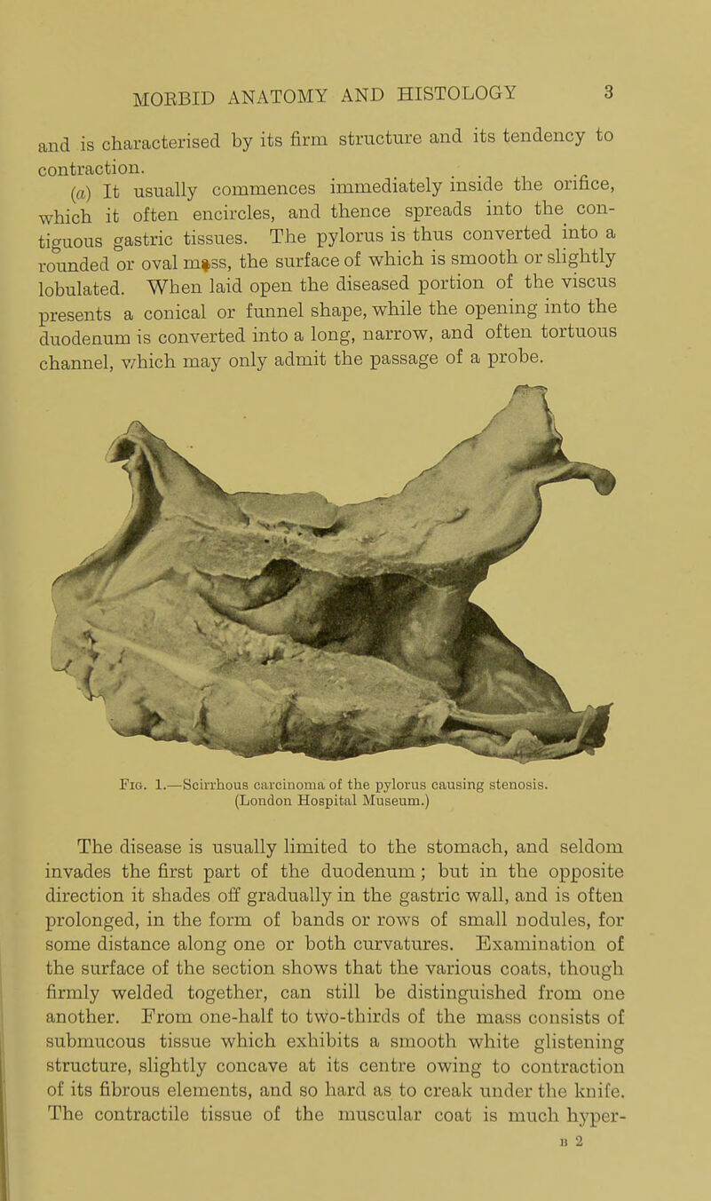 and is characterised by its firm structure and its tendency to contraction. (ft) It usually commences immediately inside the orifice, which it often encircles, and thence spreads into the con- tiguous gastric tissues. The pylorus is thus converted into a rounded or oval m»3s, the surface of which is smooth or slightly lobulated. When laid open the diseased portion of the viscus presents a conical or funnel shape, while the opening into the duodenum is converted into a long, narrow, and often tortuous channel, v/hich may only admit the passage of a probe. Fig. 1.—Scirrhous carcinoma of the pylorus causing stenosis. (London Hospital Museum.) The disease is usually limited to the stomach, and seldom invades the first part of the duodenum; but in the opposite direction it shades off gradually in the gastric wall, and is often prolonged, in the form of bands or rows of small nodules, for some distance along one or both curvatures. Examination of the surface of the section shows that the various coats, though firmly welded together, can still be distinguished from one another. From one-half to two-thirds of the mass consists of submucous tissue which exhibits a smooth white glistening structure, slightly concave at its centre owing to contraction of its fibrous elements, and so hard as to creak under the knife. The contractile tissue of the muscular coat is much hyper- u 2