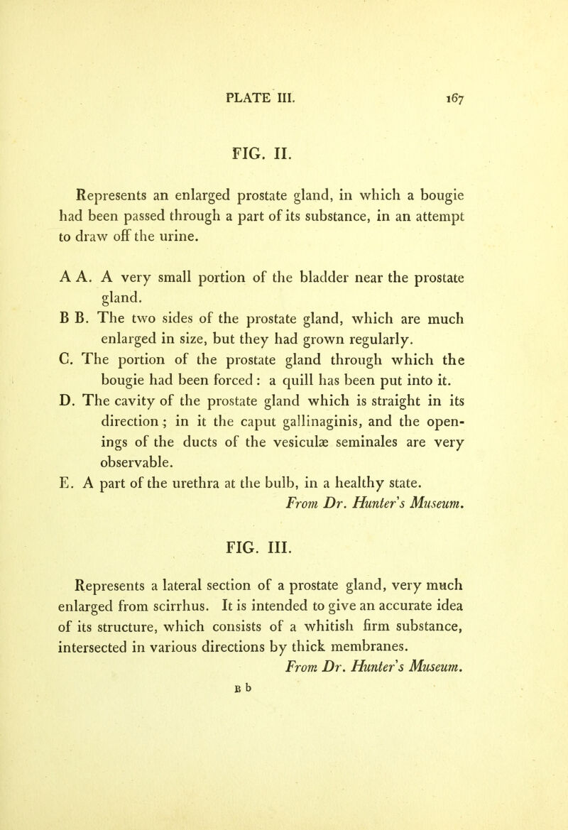 FIG. II. Represents an enlarged prostate gland, in which a bougie had been passed through a part of its substance, in an attempt to draw off the urine. A A. A very small portion of the bladder near the prostate gland. B B. The two sides of the prostate gland, which are much enlarged in size, but they had grown regularly. C. The portion of the prostate gland through which the bougie had been forced : a quill has been put into it. D. The cavity of the prostate gland which is straight in its direction ; in it the caput gallinaginis, and the open- ings of the ducts of the vesiculae seminales are very observable. E. A part of the urethra at the bulb, in a healthy state. From Dr. Hunter s Museum. FIG. III. Represents a lateral section of a prostate gland, very much enlarged from scirrhus. It is intended to give an accurate idea of its structure, which consists of a whitish firm substance, intersected in various directions by thick membranes. From Dr. Hunter s Museum.