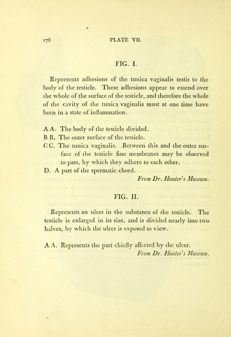 FIG. I. Represents adhesions of the tunica vaginalis testis to the body of the testicle. These adhesions appear to extend over the whole of the surface of the testicle, and therefore the whole of the cavity of the tunica vaginalis must at one time have been in a state of inflammation. A A. The body of the testicle divided. B B. The outer surface of the testicle. C G. The tunica vaginalis. Between this and the outer sur- face of the testicle fine membranes may be observed to pass, by which they adhere to each other. D. A part of the spermatic chord. From Dr. Hunter s Museum. FIG. II. Represents an ulcer in the substance of the testicle. The testicle is enlarged in its size, and is divided nearly into two halves, by which the ulcer is exposed to view. A A. Represents the part chiefly affected by the ulcer. From Dr. Hunter s Museum.