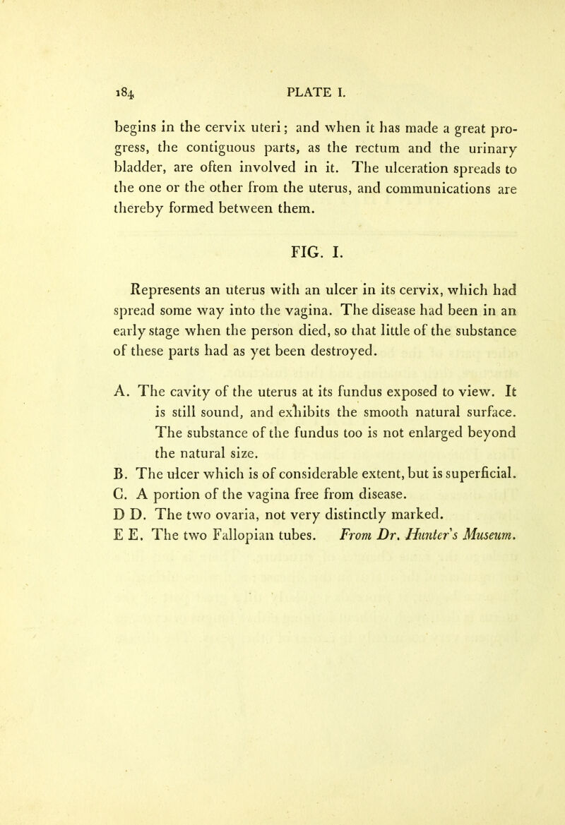 begins in the cervix uteri; and when it has made a great pro- gress, the contiguous parts, as the rectum and the urinary bladder, are often involved in it. The ulceration spreads to the one or the other from the uterus, and communications are thereby formed between them. FIG. I. Represents an uterus with an ulcer in its cervix, which had spread some way into the vagina. The disease had been in an early stage when the person died, so that little of the substance of these parts had as yet been destroyed. A. The cavity of the uterus at its fundus exposed to view. It is still sound, and exhibits the smooth natural surface. The substance of the fundus too is not enlarged beyond the natural size. B. The ulcer which is of considerable extent, but is superficial. C. A portion of the vagina free from disease. D D. The two ovaria, not very distinctly marked. E E. The two Fallopian tubes. From Dr. Hunter s Museum.