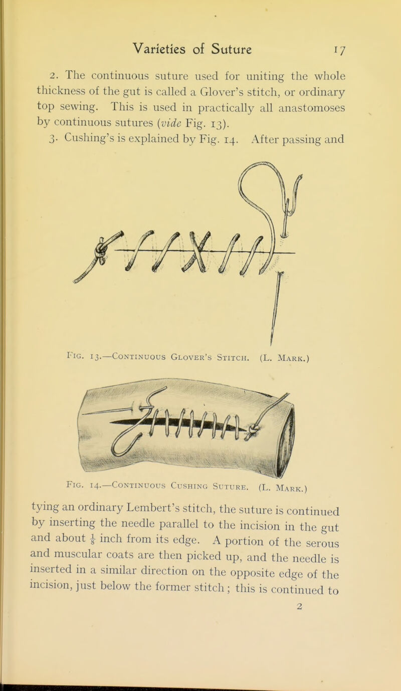 2. The continuous suture used for uniting the whole thickness of the gut is called a Glover's stitch, or ordinary top sewing. This is used in practically all anastomoses by continuous sutures {vide Fig. 13). 3. Cushing's is explained by Fig. 14. After passing and Fig. 13.—Continuous Glover's Stitch. (L. Mark.) Fig. 14.—Continuous Cushing Suture. (L. Mark.) tying an ordinary Lembert's stitch, the suture is continued by inserting the needle parallel to the incision in the gut and about i inch from its edge. A portion of the serous and muscular coats are then picked up, and the needle is inserted in a similar direction on the opposite edge of the incision, just below the former stitch ; this is continued to 2