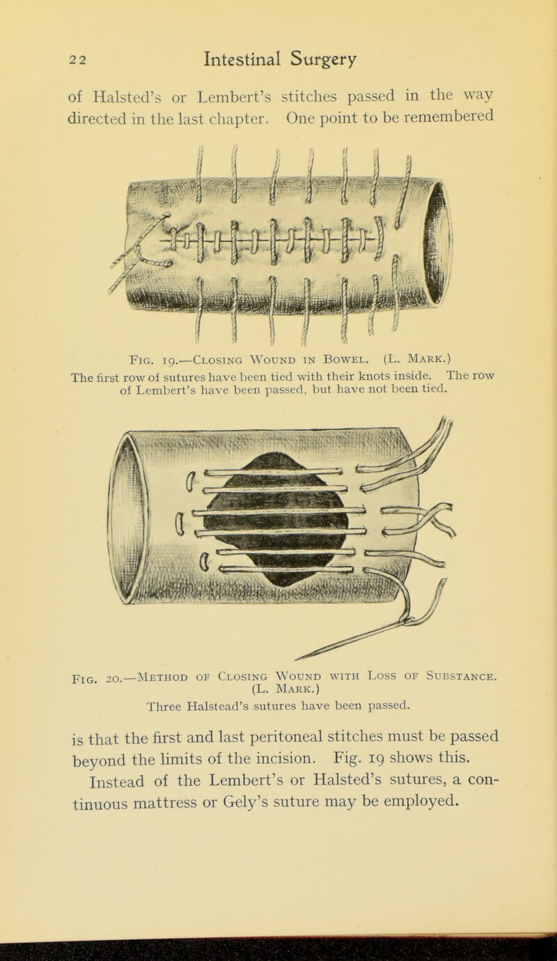 of Halsted's or Lembert's stitches passed in the way directed in the last chapter. One point to be remembered Fig. 19.—Closing Wound in Bowel. (L. Mark.) The first row of sutures have been tied with their knots inside. The row of Lembert's have been passed, but have not been tied. YiG. 20.—Method of Closing Wound with Loss of Substance. (L. Mark.) Three Halstead's sutures have been passed. is that the first and last peritoneal stitches must be passed beyond the limits of the incision. Fig. 19 shows this. Instead of the Lembert's or Halsted's sutures, a con- tinuous mattress or Gely's suture may be employed.